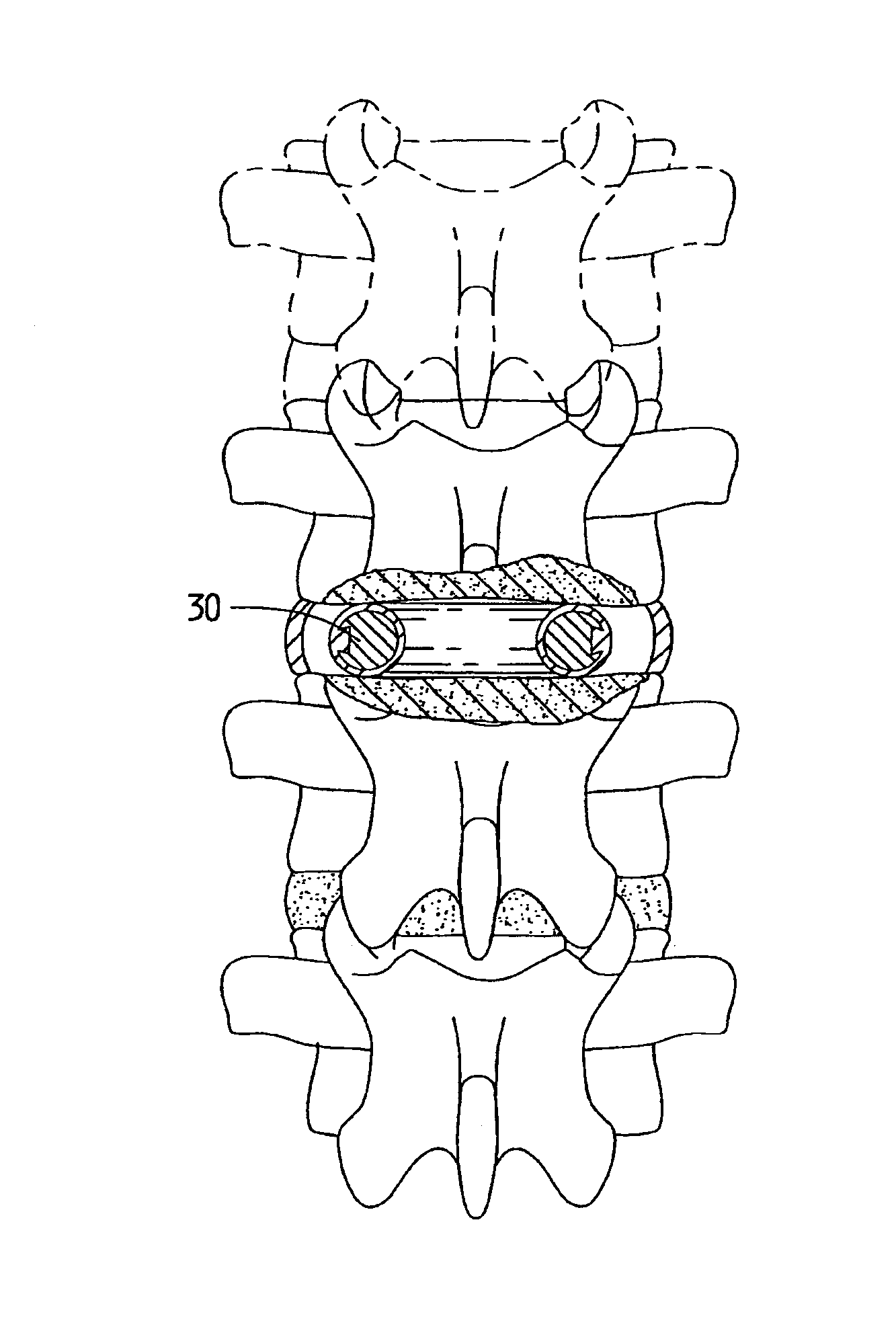 Spinal implant and method of use