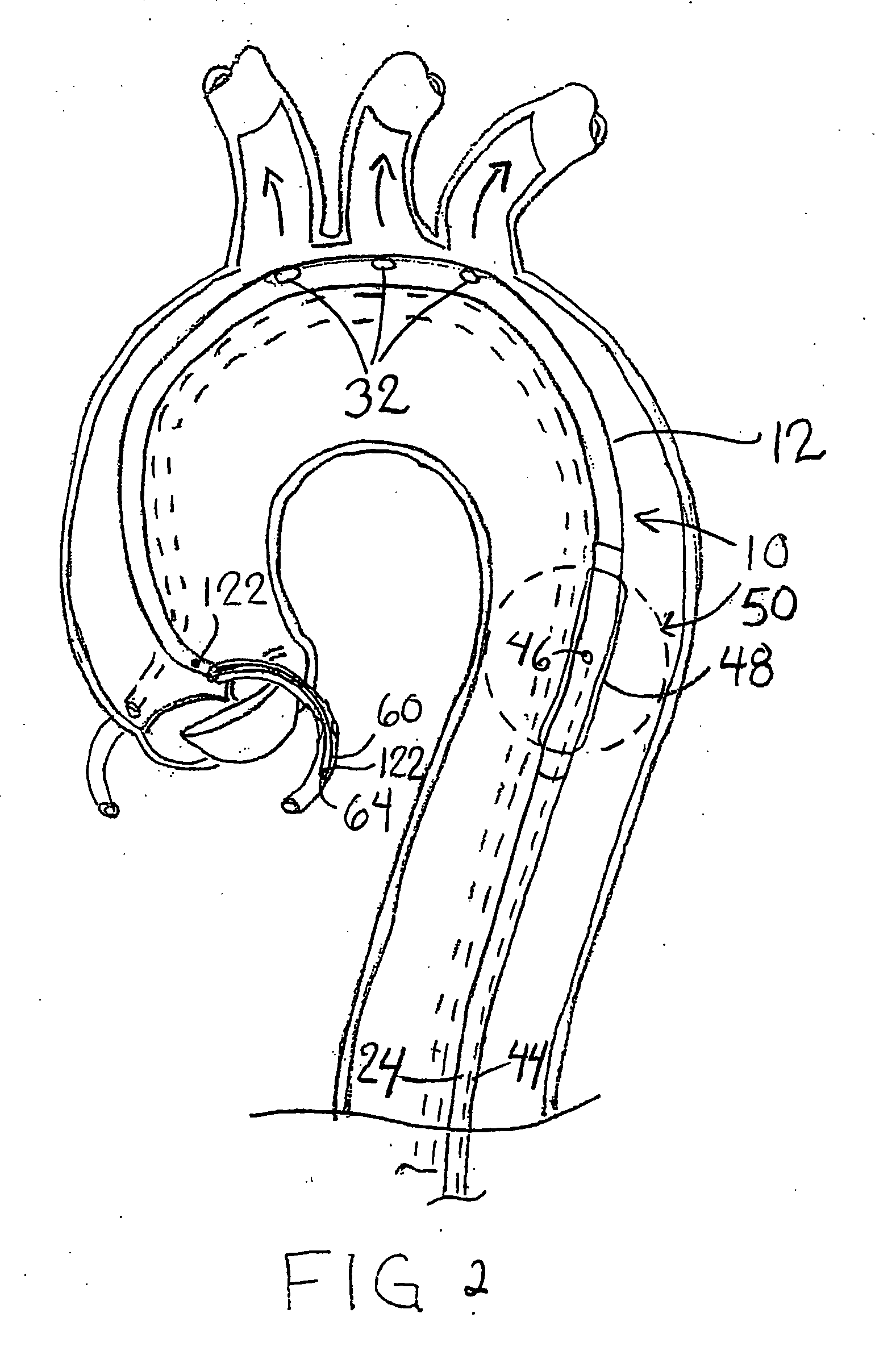 Method and apparatus for treating acute myocardial infarction with hypothermic perfusion