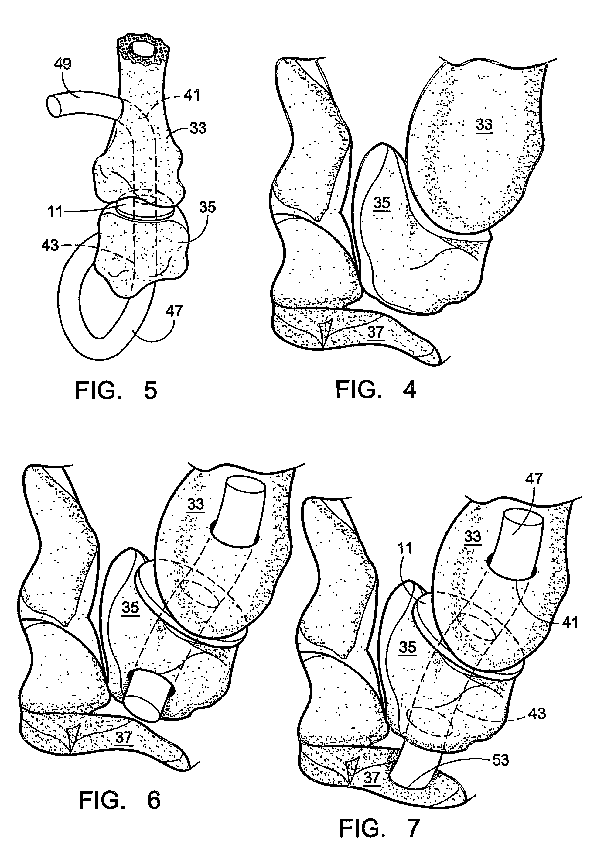 Interpositional biarticular disk implant