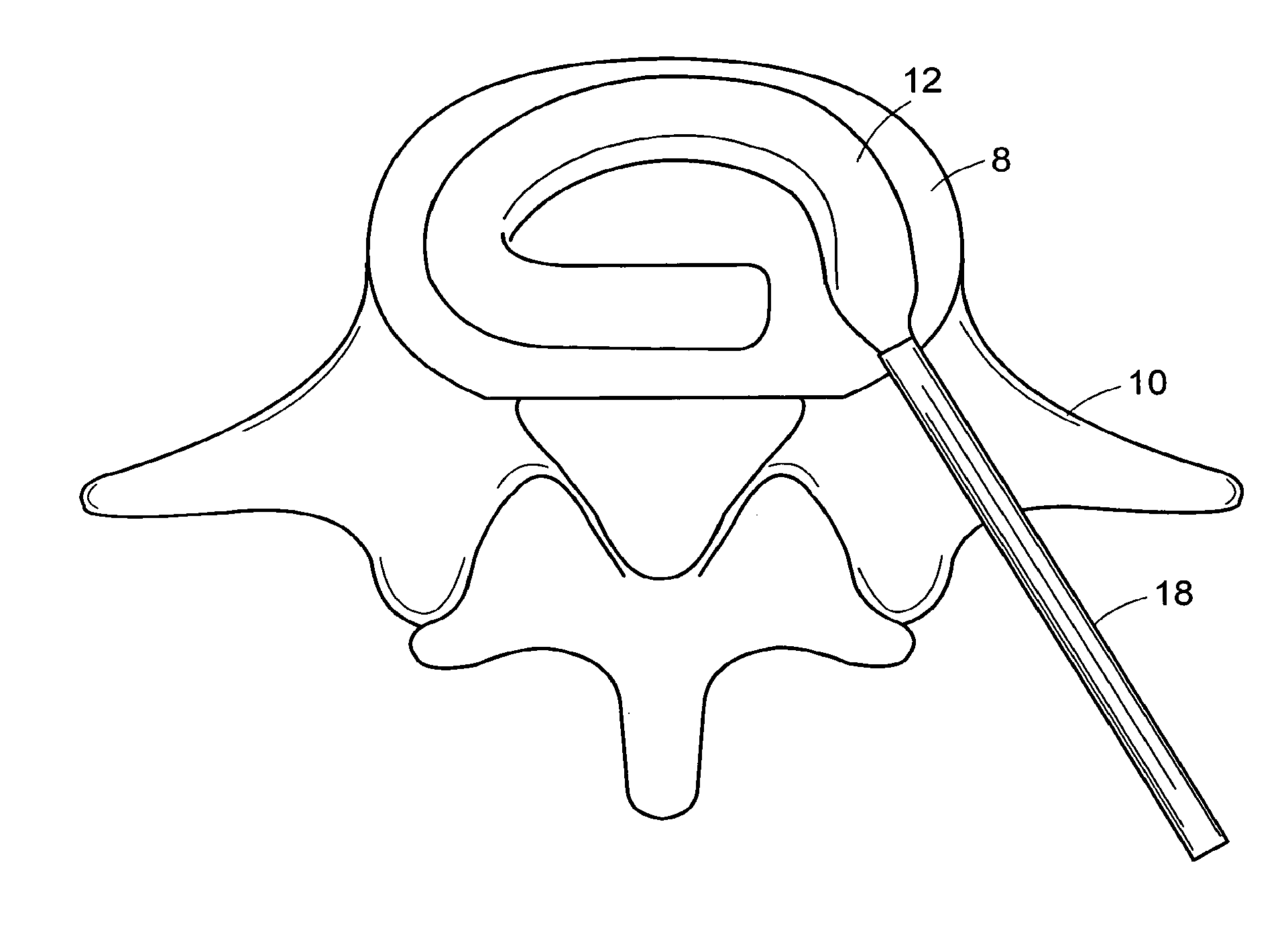 In-situ formed intervertebral fusion device and method