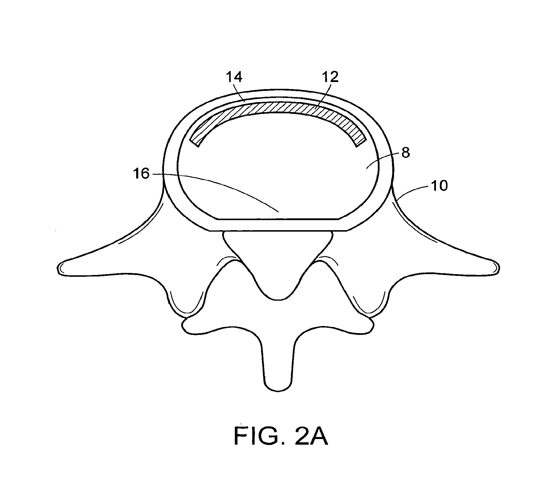 In-situ formed intervertebral fusion device and method