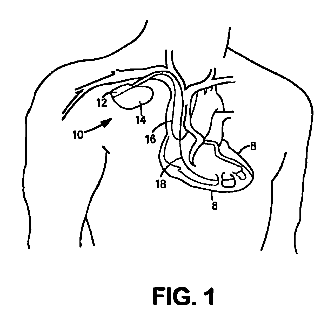 Ultrasound methods and implantable medical devices using same