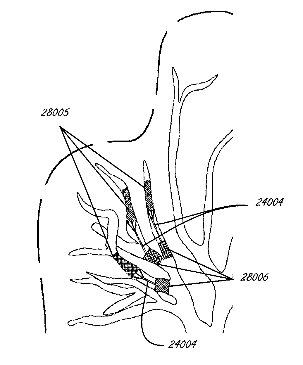 Devices and methods for lung volume reduction