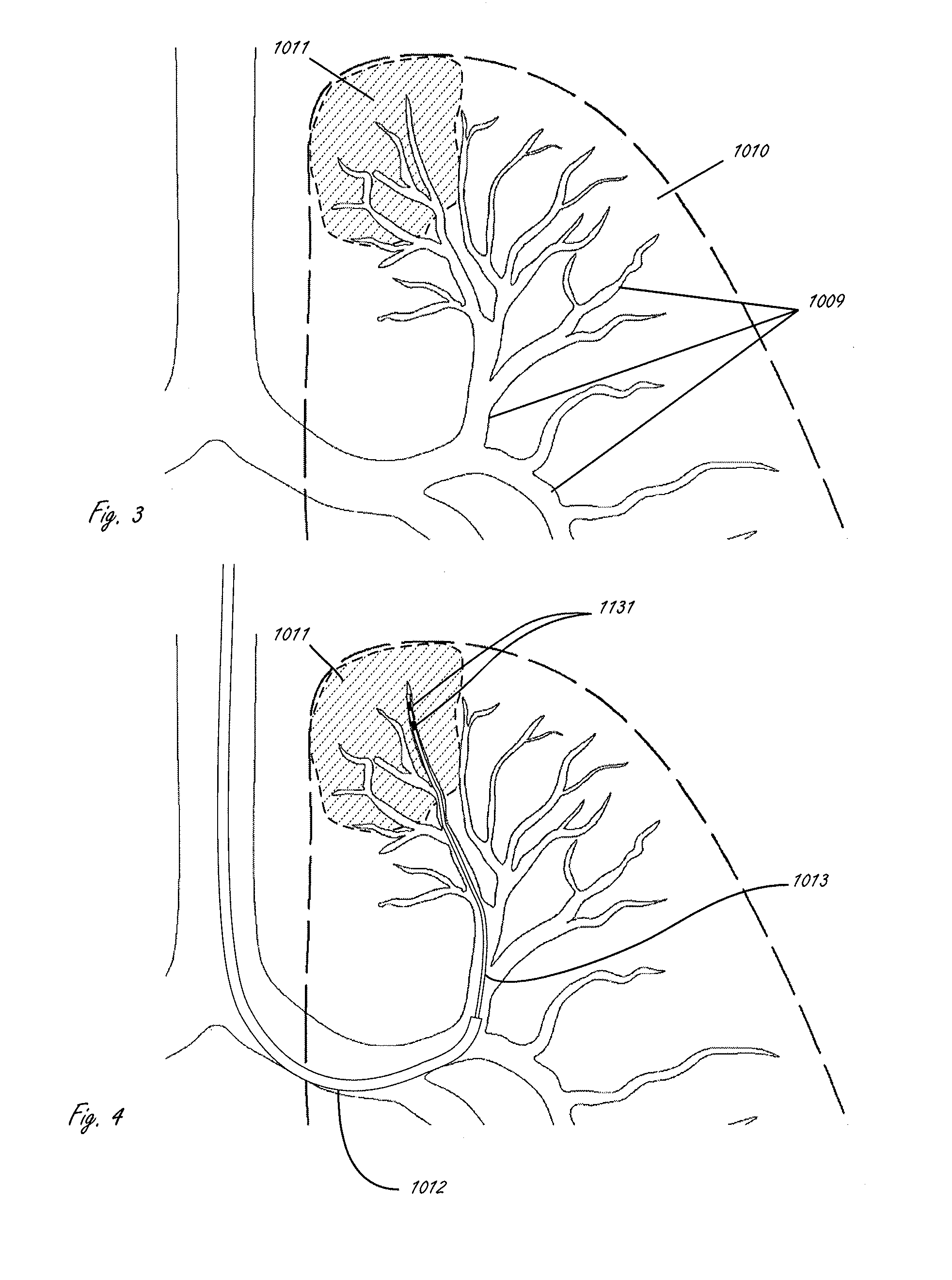 Devices and methods for lung volume reduction