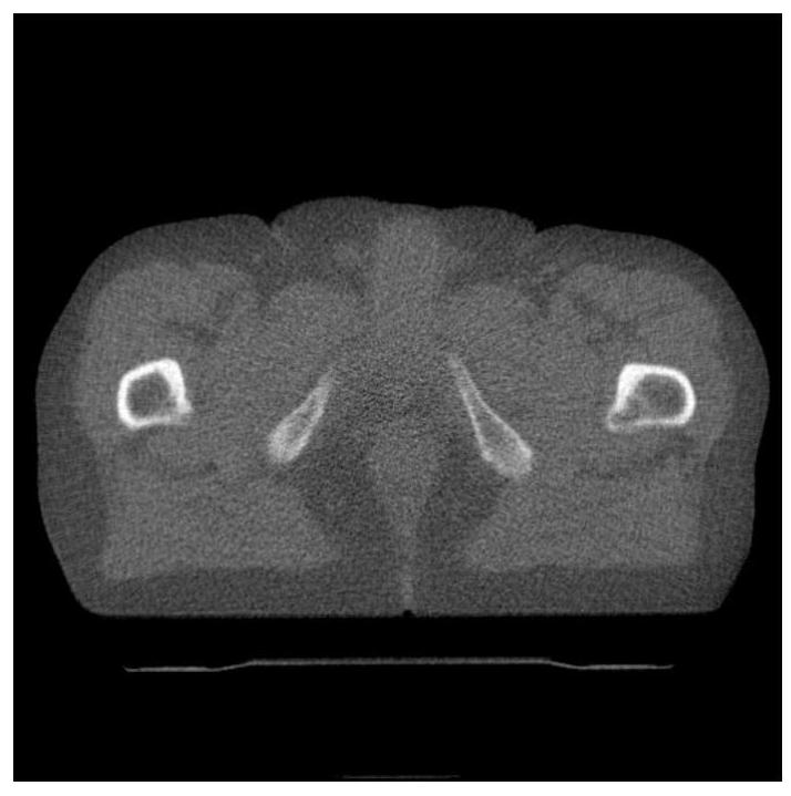 MVCT Image Texture Enhancement Method Based on Double Regular Constraints