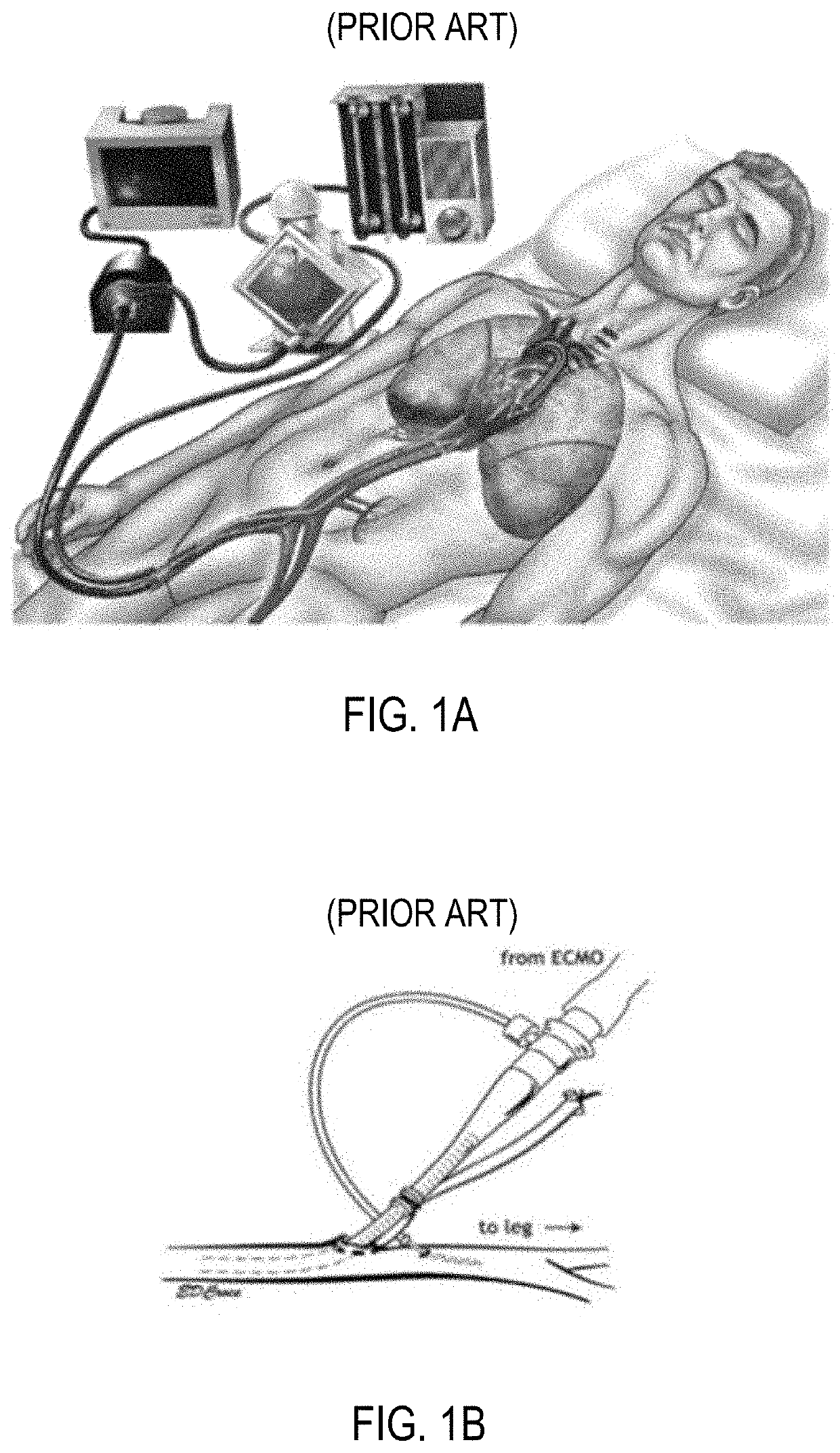 Systems and methods for diverting blood flow in blood vessels