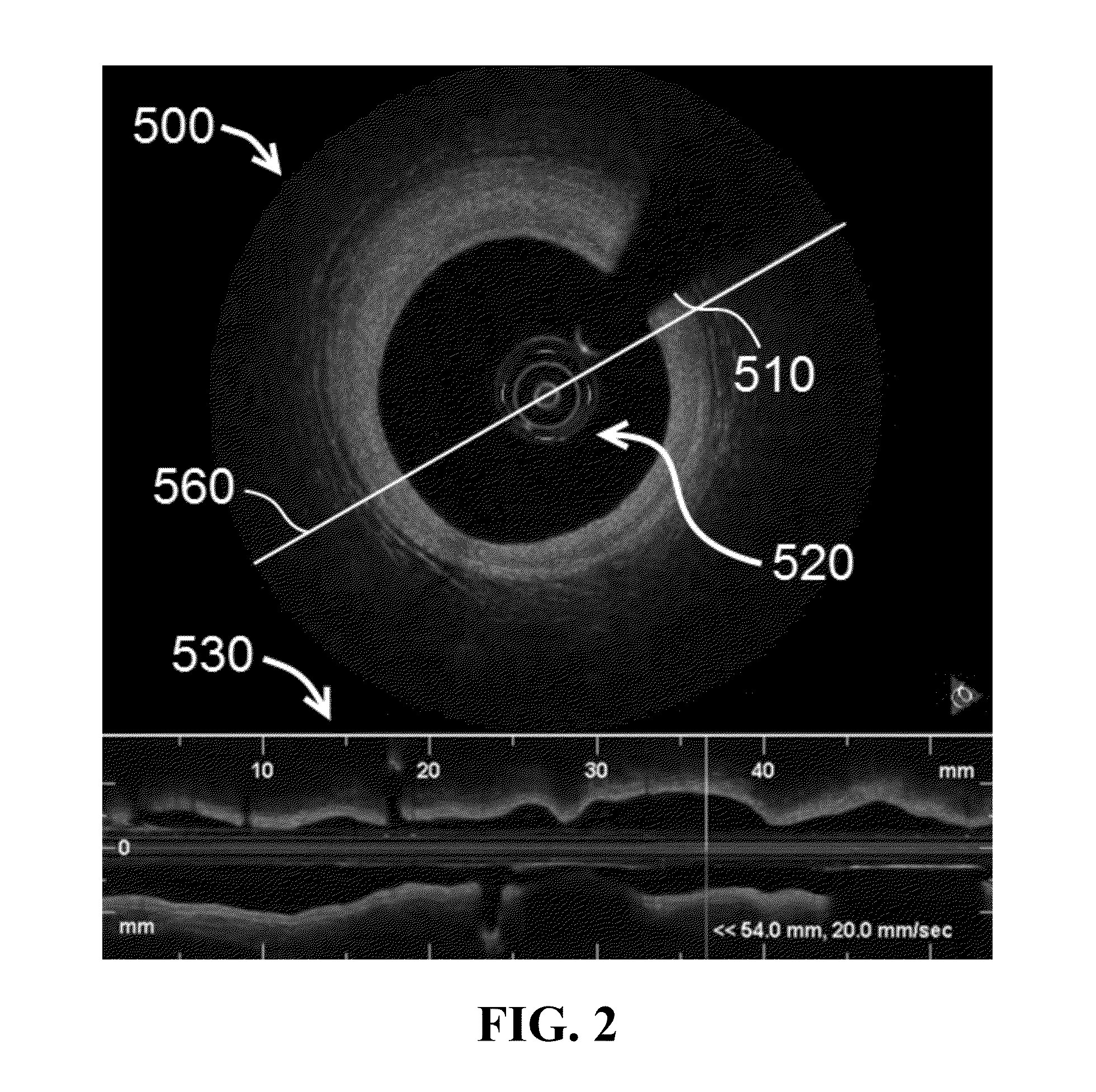 Apparatus and methods for identifying and evaluating bright spot indications observed through optical coherence tomography