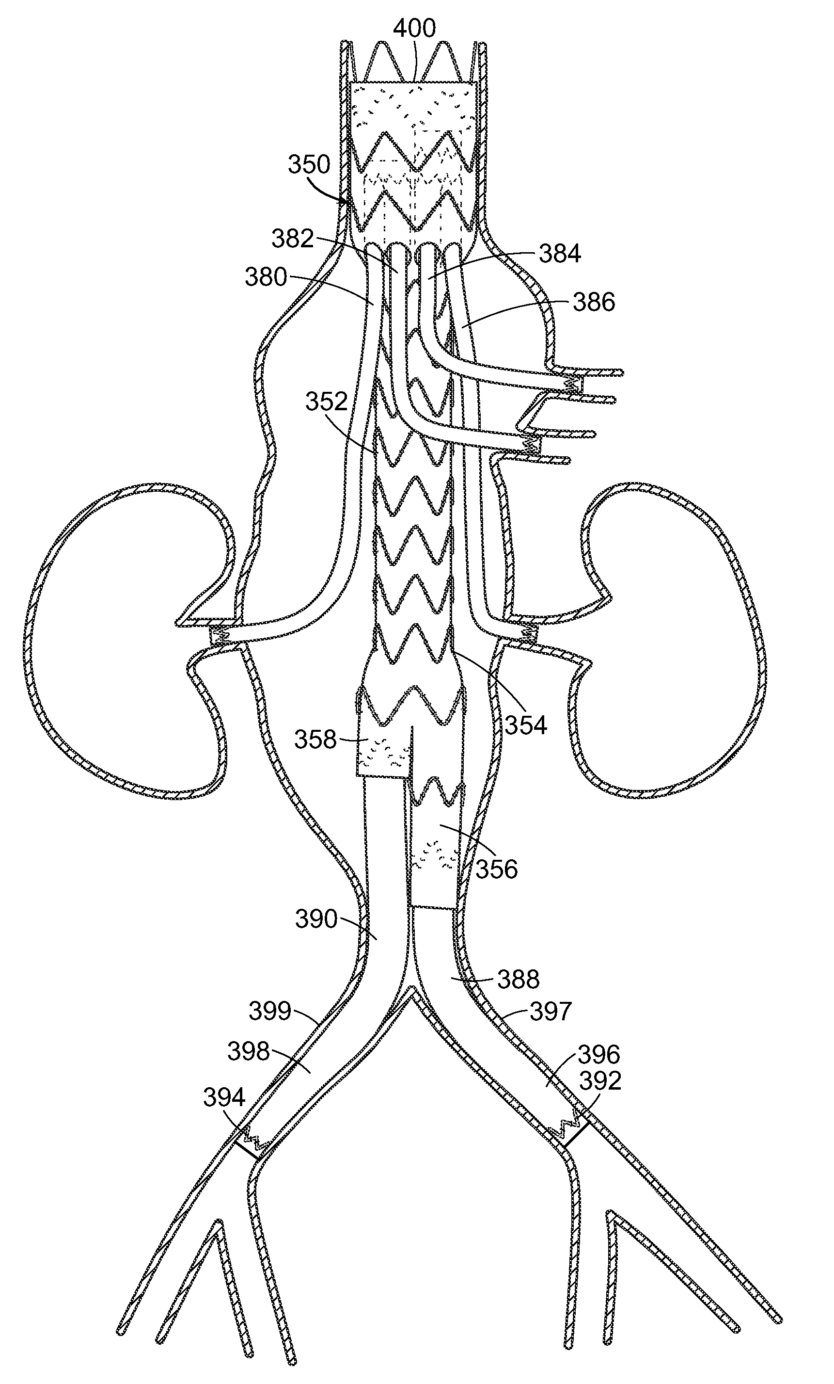 Vascular repair devices and methods of use