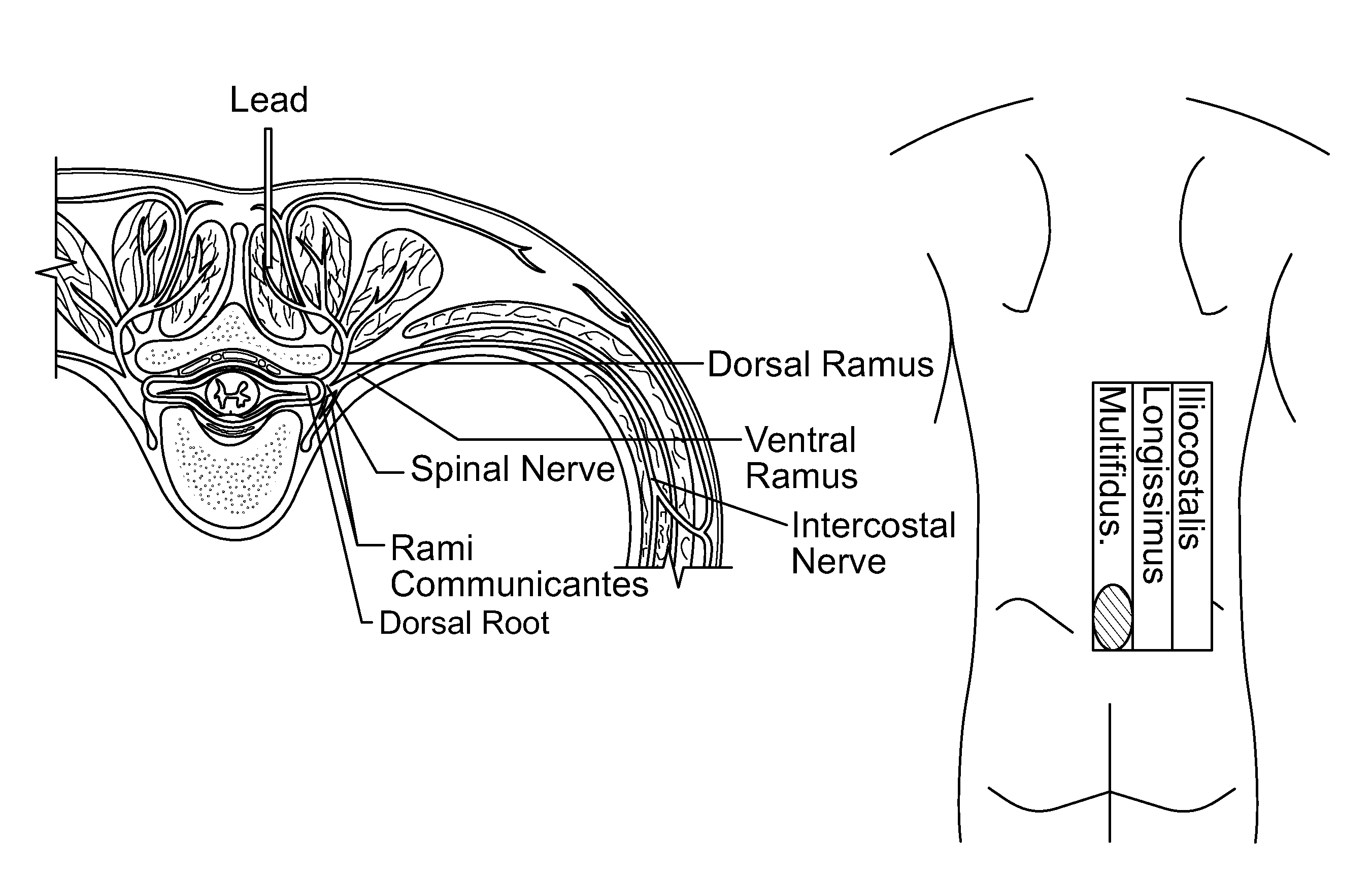 Systems and methods related to the treatment of back pain
