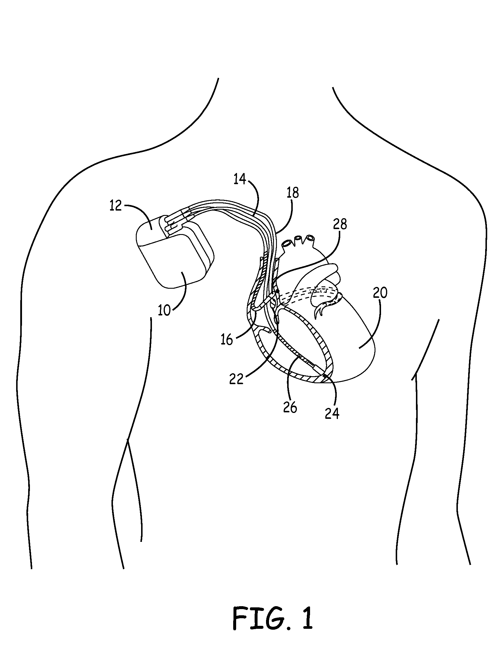 System and method of determining cardiac pressure