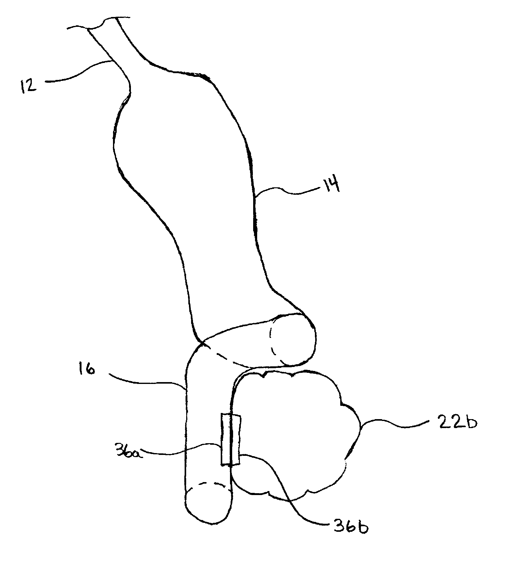 Incisionless Gastric Bypass Method And Devices