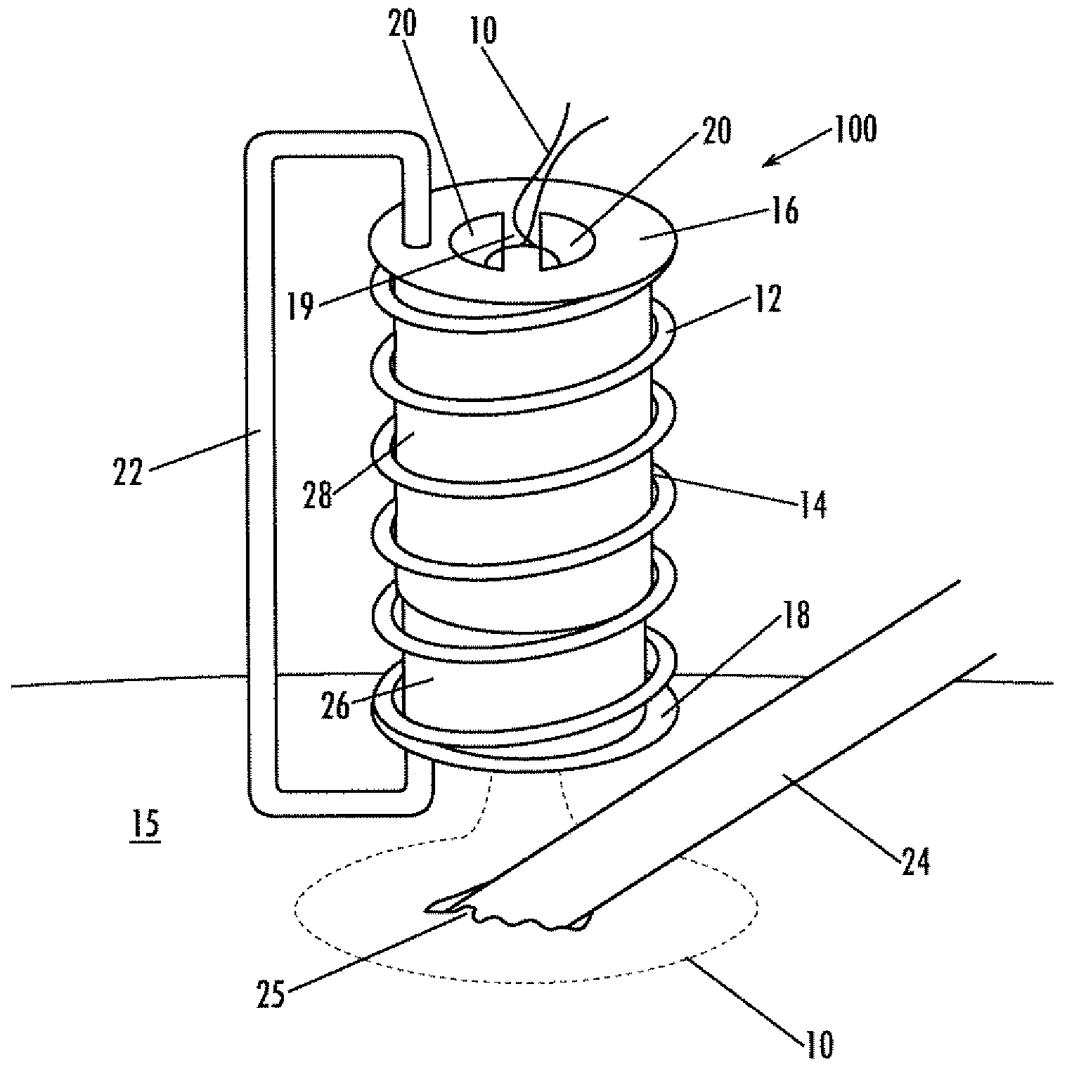 Implantable purse string suture tensioning device