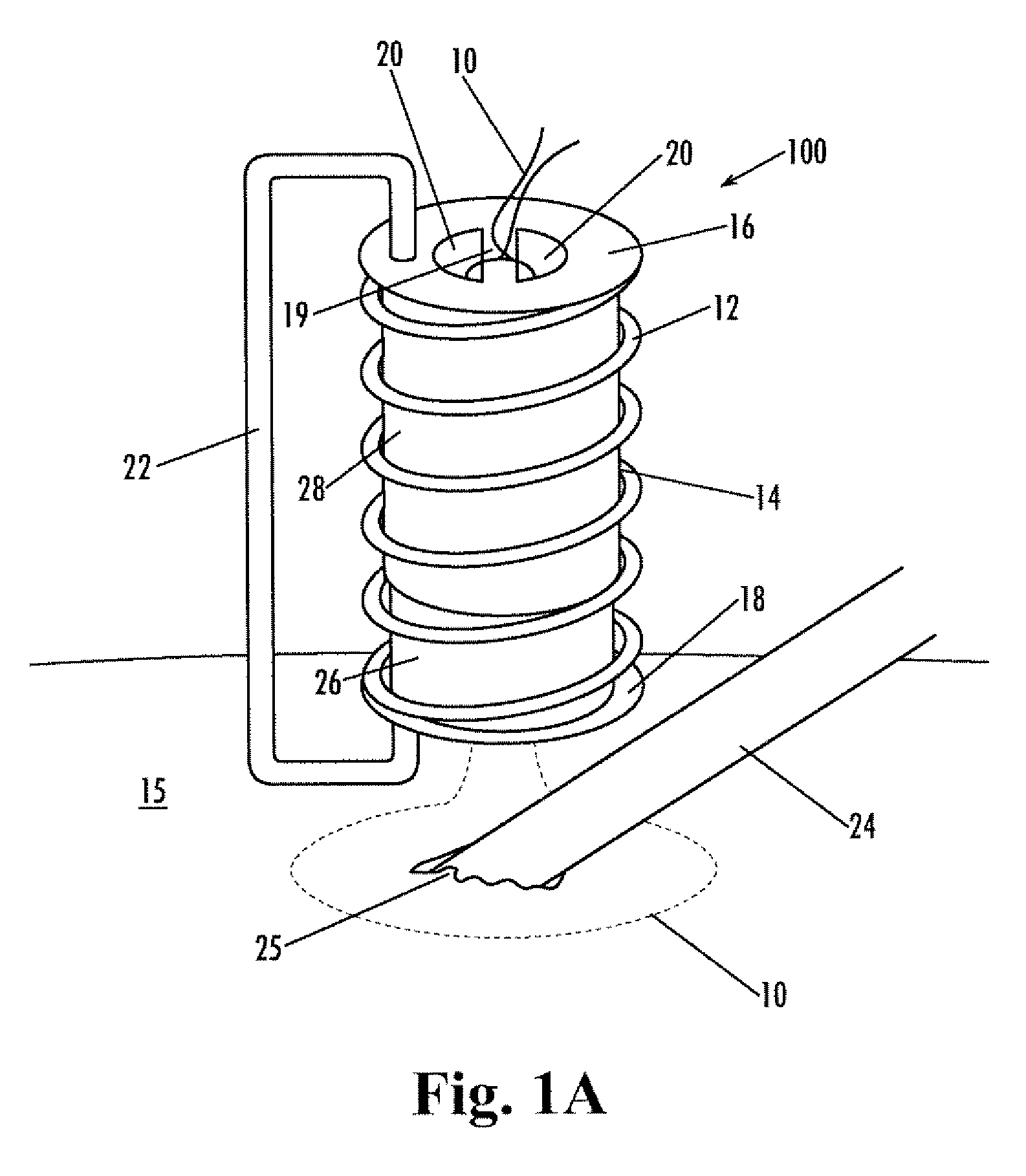 Implantable purse string suture tensioning device