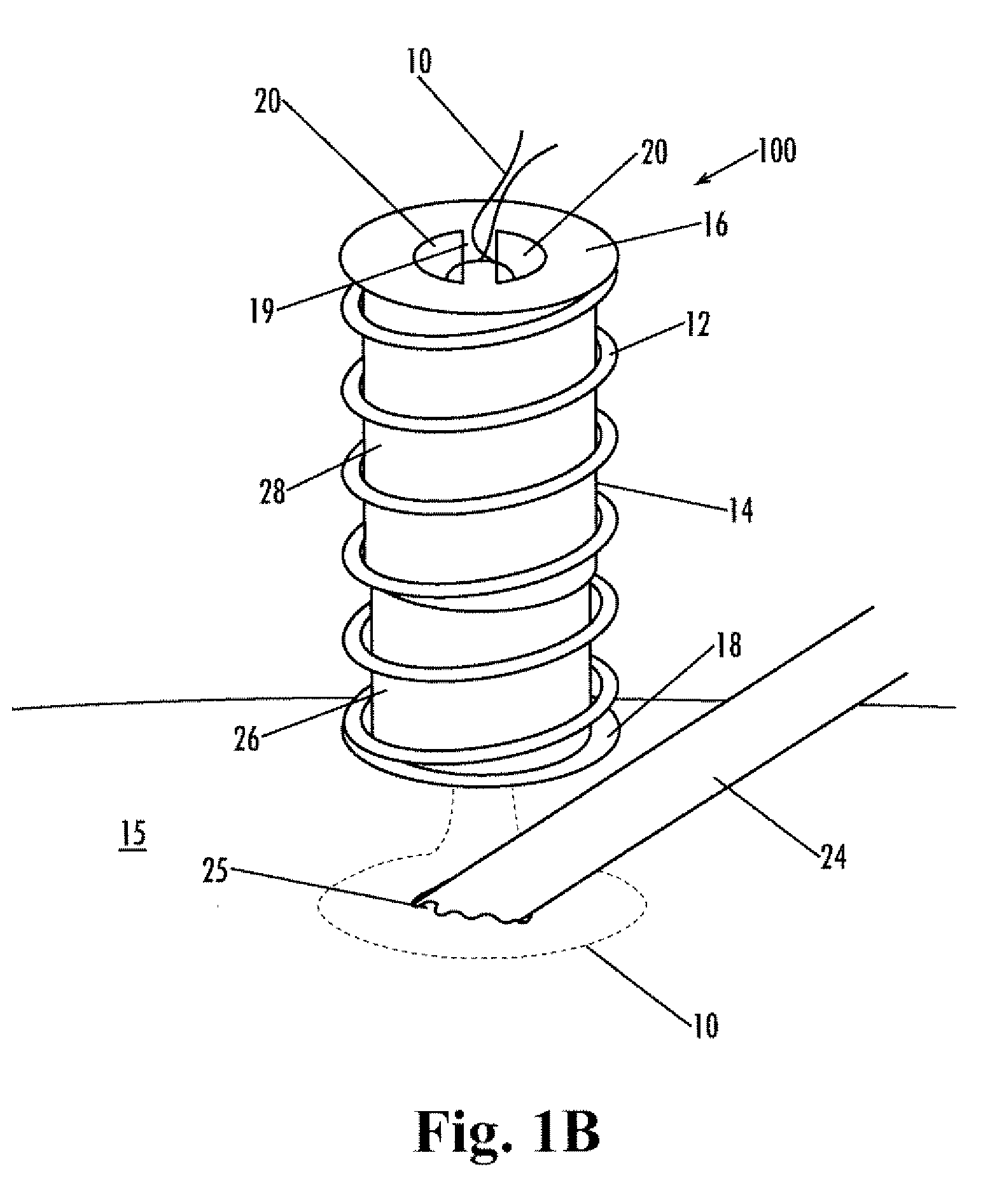 Implantable purse string suture tensioning device