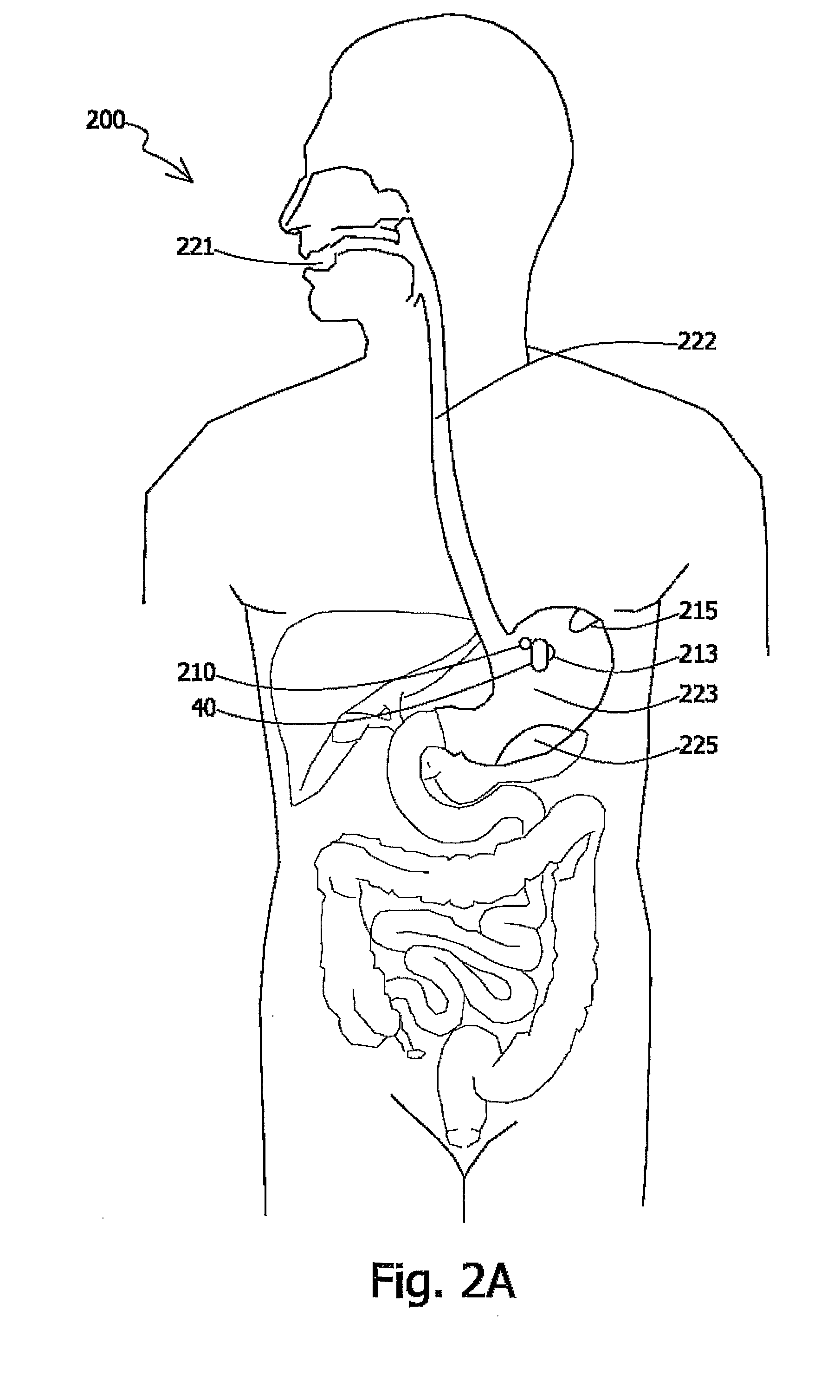 System and Device for in Vivo Procedures