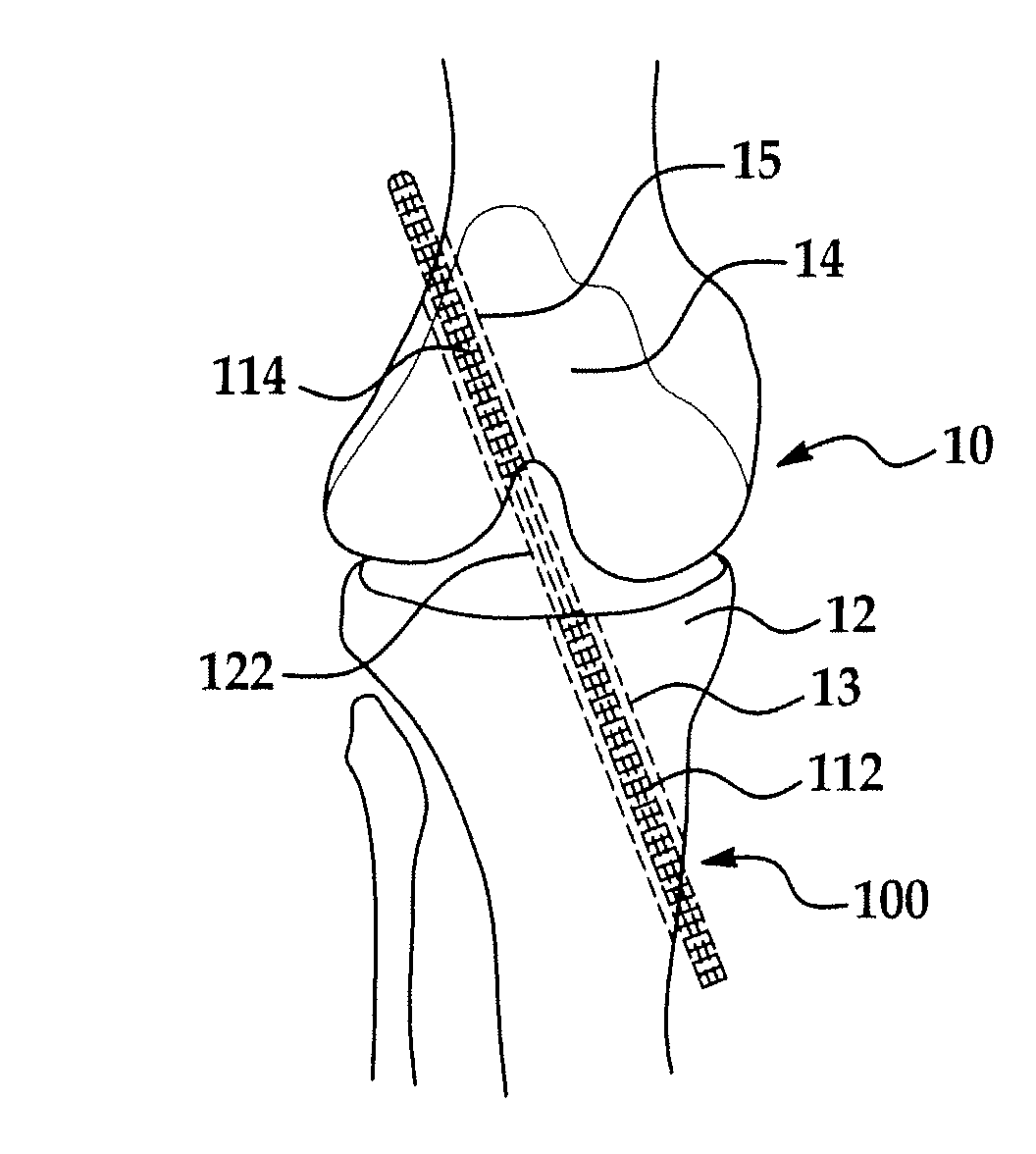 Prosthetic device and method of manufacturing the same