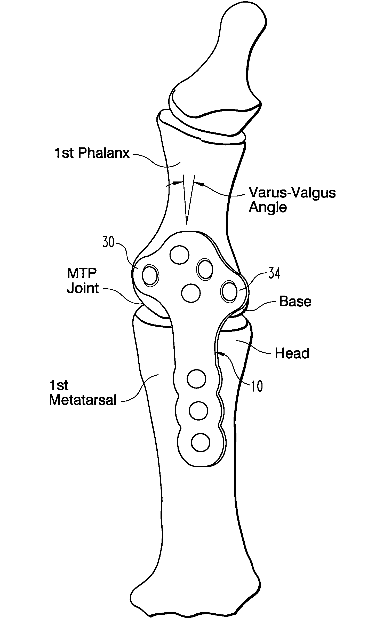 Plate for fusion of the metatarso-phalangeal joint