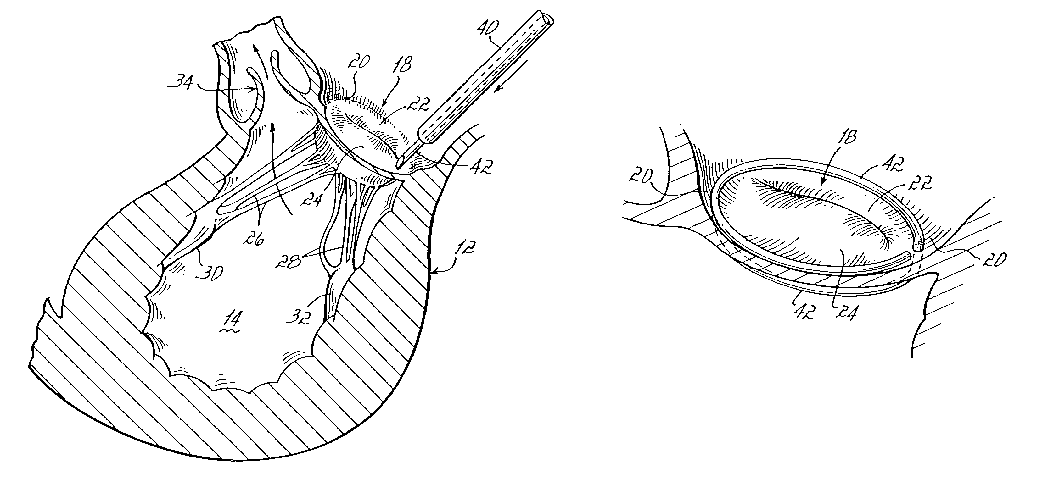 Annuloplasty devices and related heart valve repair methods