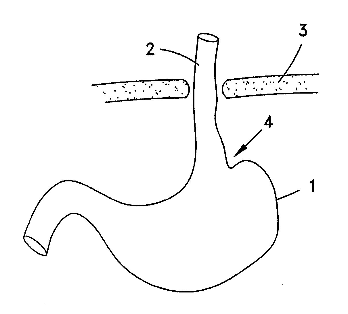 Method of performing surgical procedures on patients suffering from hiatal hernia