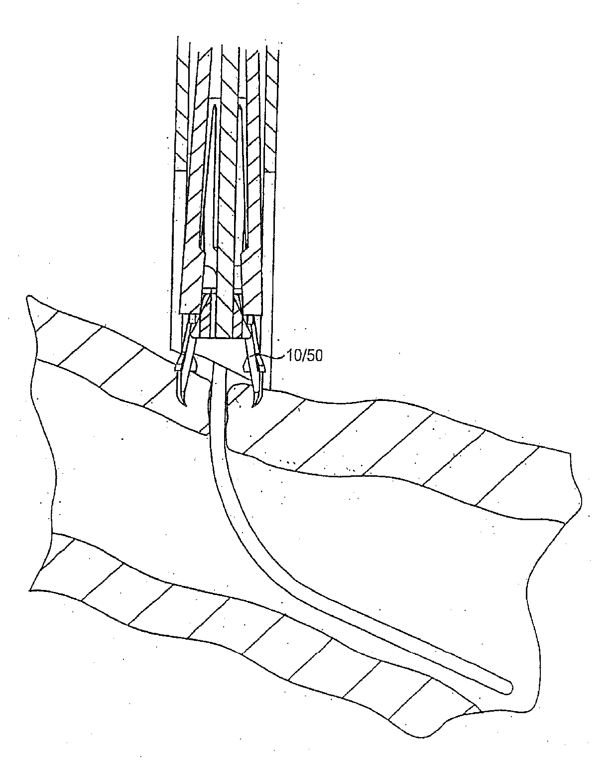 Wound site management and wound closure device