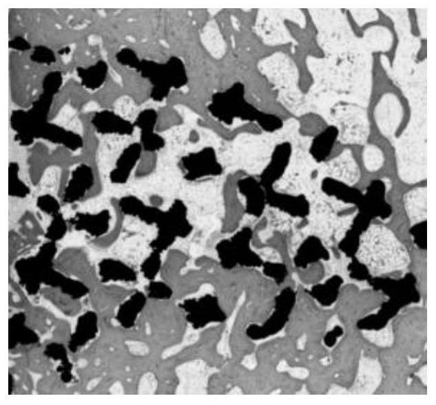 Porous metal implant containing artificial bone meal and preparation method of porous metal implant