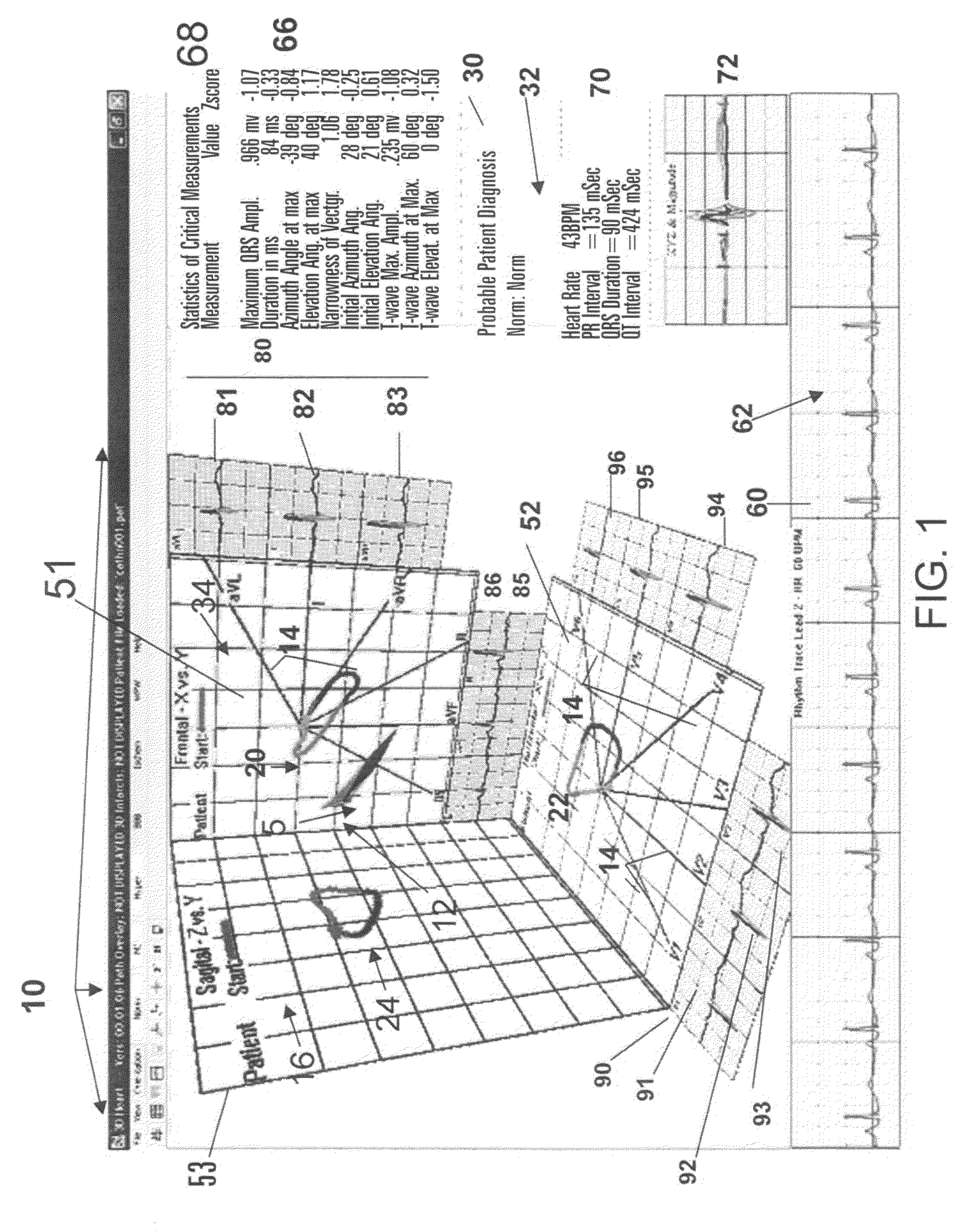 Location and displaying an ischemic region for ECG diagnostics