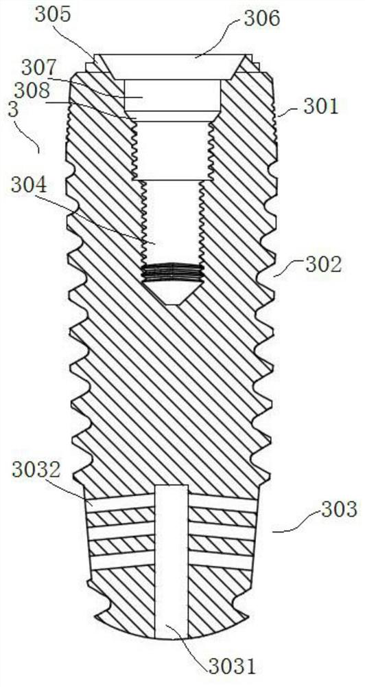 a dental implant