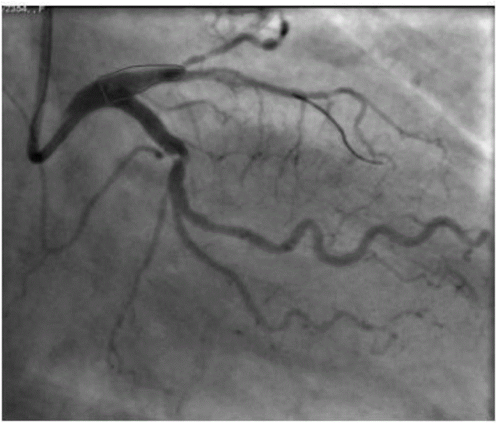 Degradable individual non-column-shaped bionic medicine eluting coronary stent