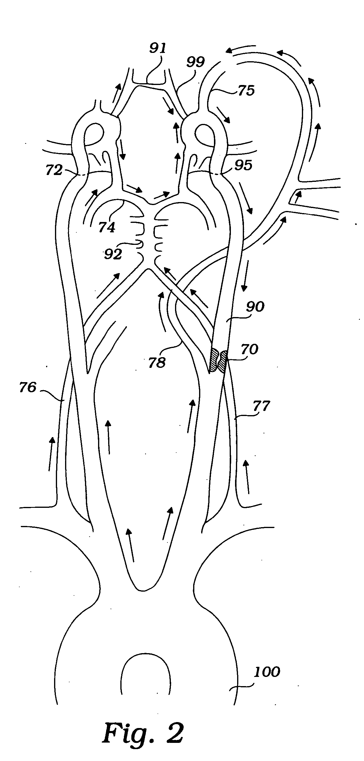 Devices and methods for preventing distal embolization using flow reversal and perfusion augmentation within the cerebral vasculature
