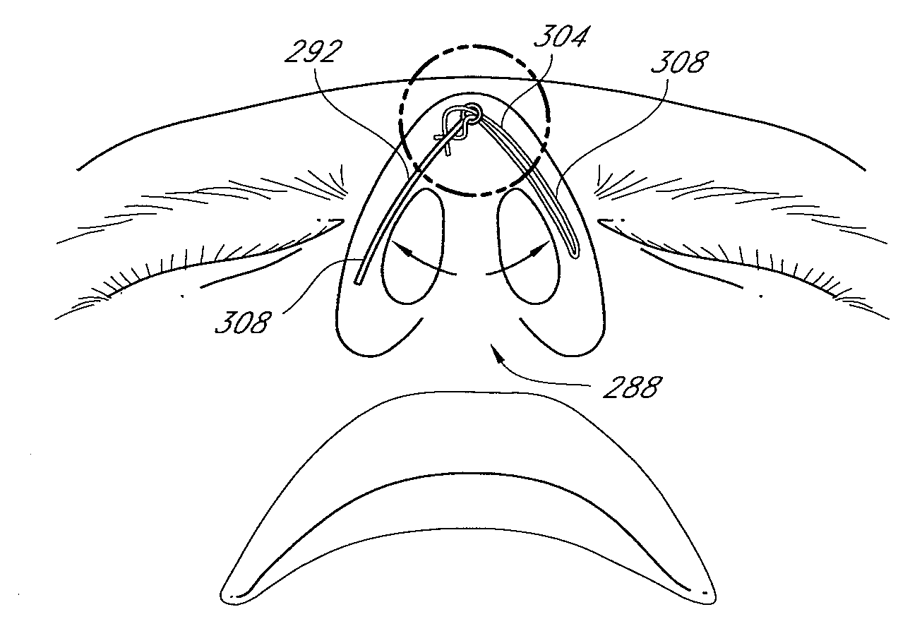 Methods and devices for rhinoplasty and treating internal valve stenosis