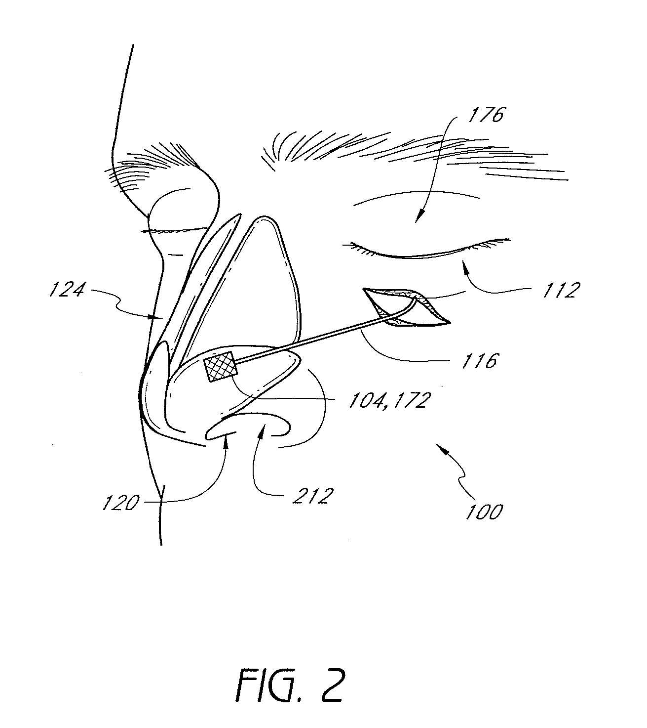 Methods and devices for rhinoplasty and treating internal valve stenosis