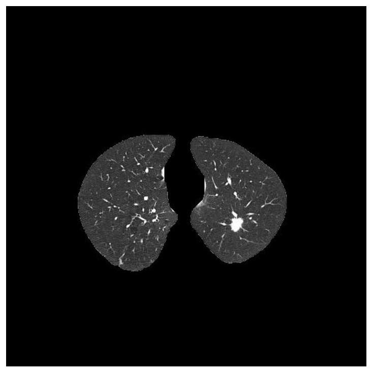 A Nodule Screening Method for Lung CT Images Based on Generalized S-Transform and Teager Attributes