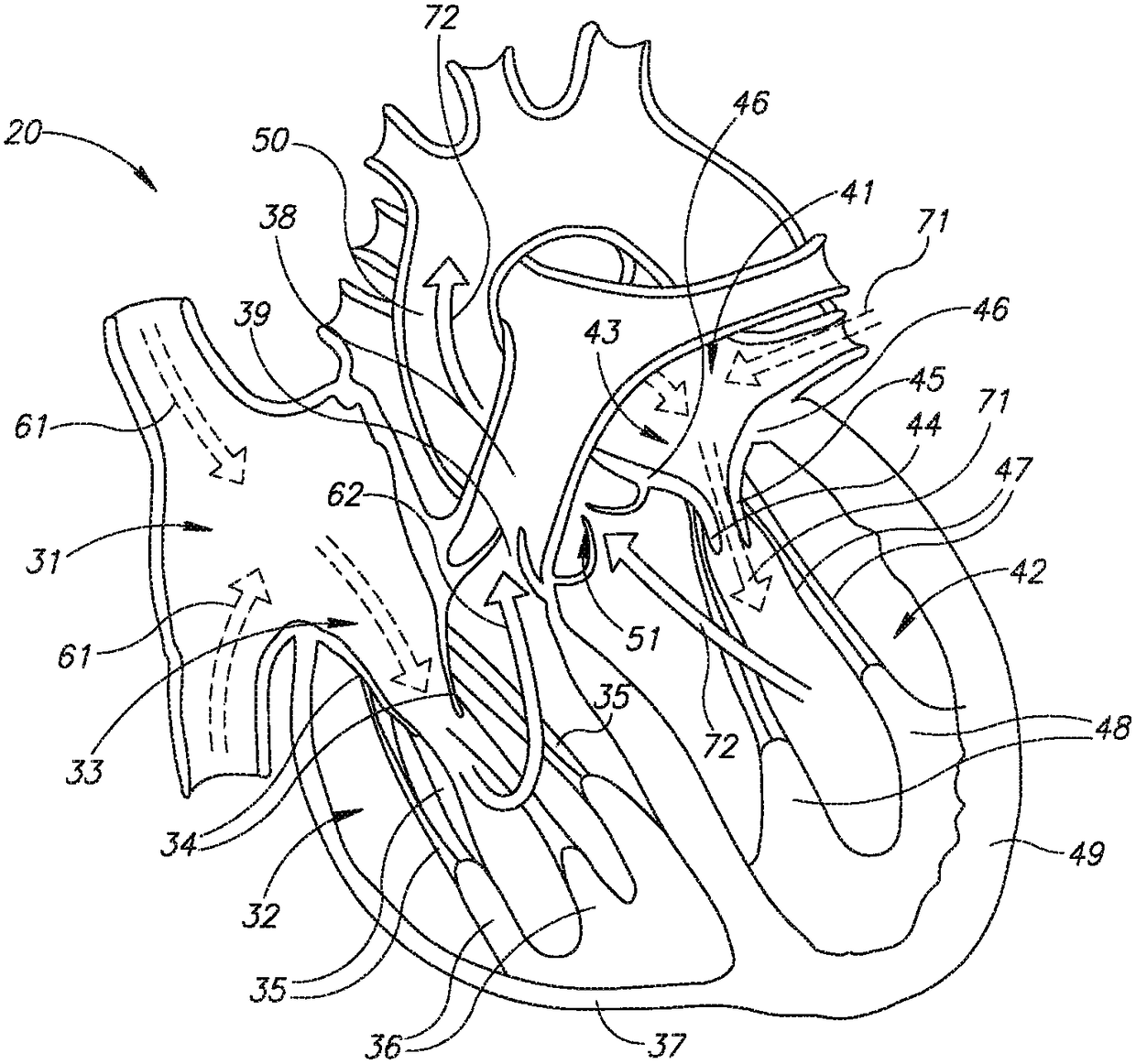 Cardiac Prosthesis and Its Deployment