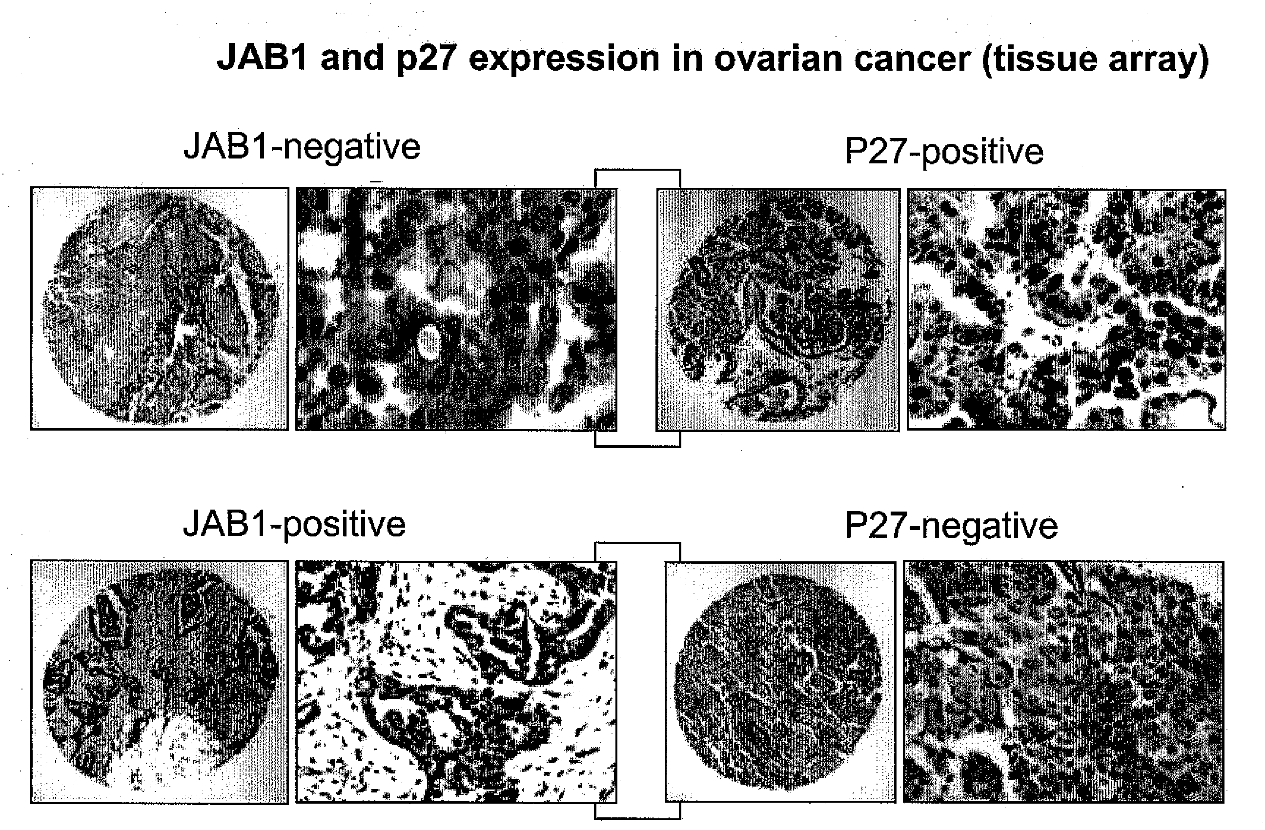 Jab1 as a prognostic marker and a therapeutic target for human cancer