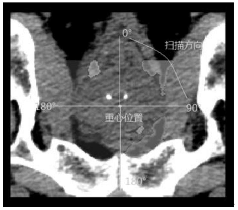 Methods of Prostate Segmentation in Medical Images