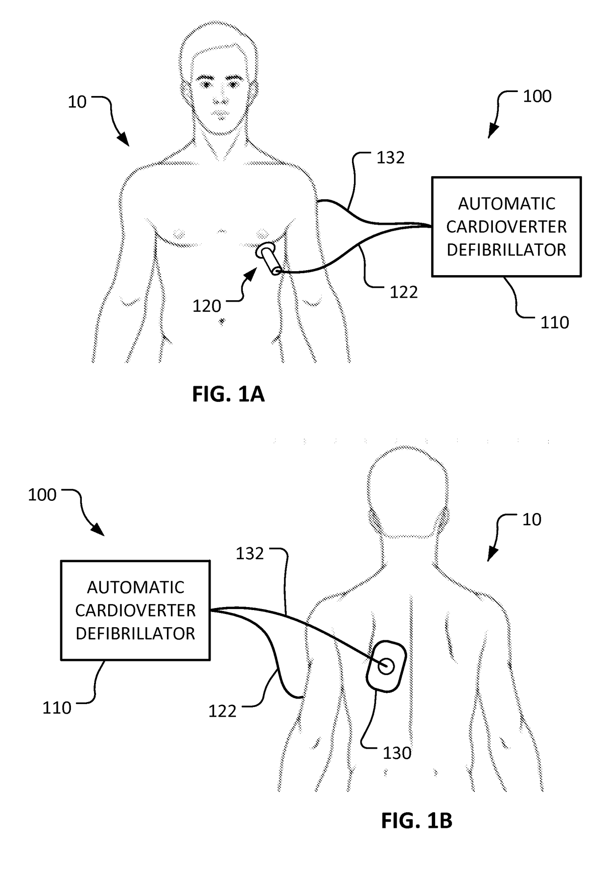 Percutaneous temporary epicardial pacemaker system