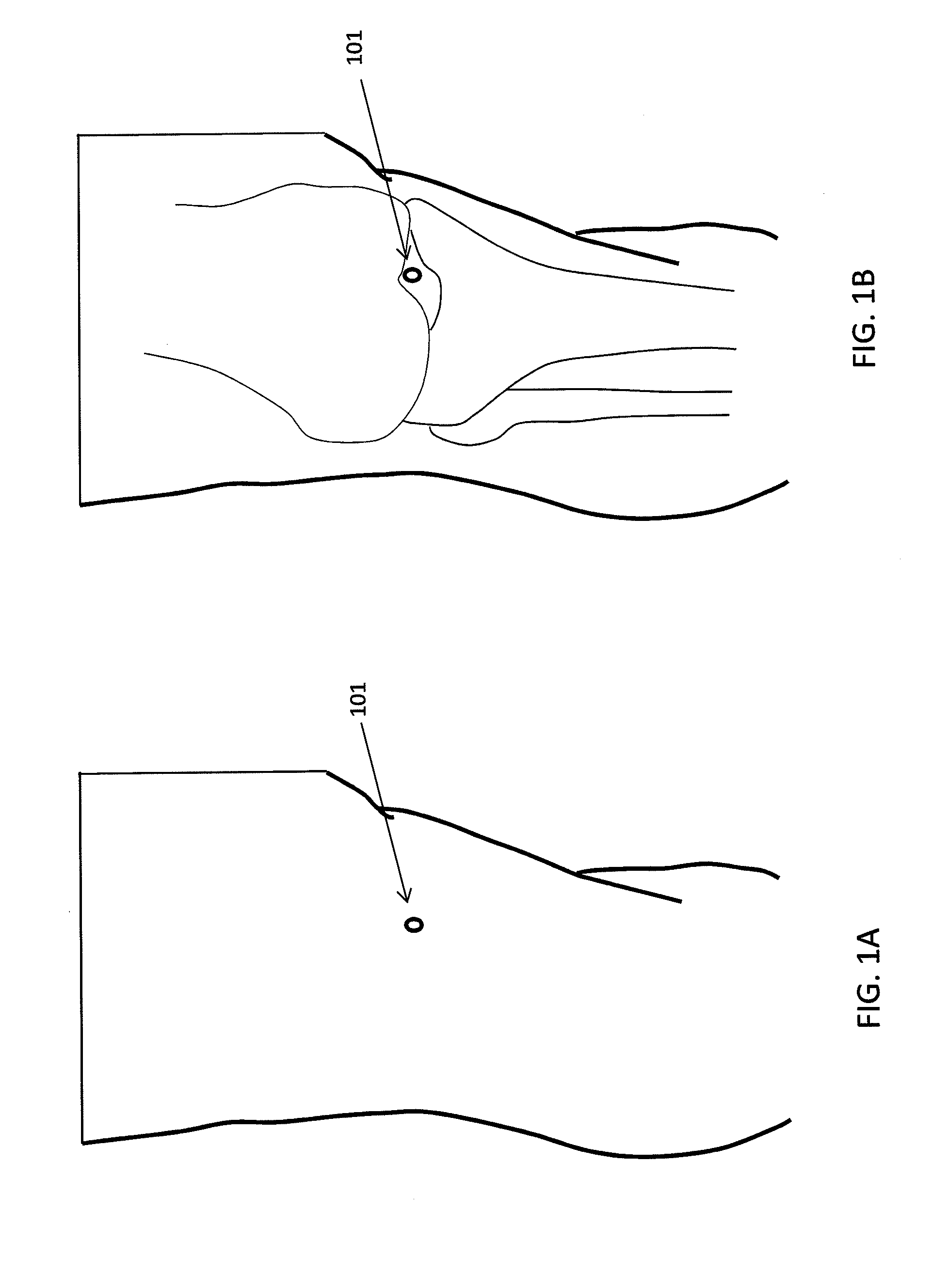 Methods and devices for preventing tissue bridging while suturing