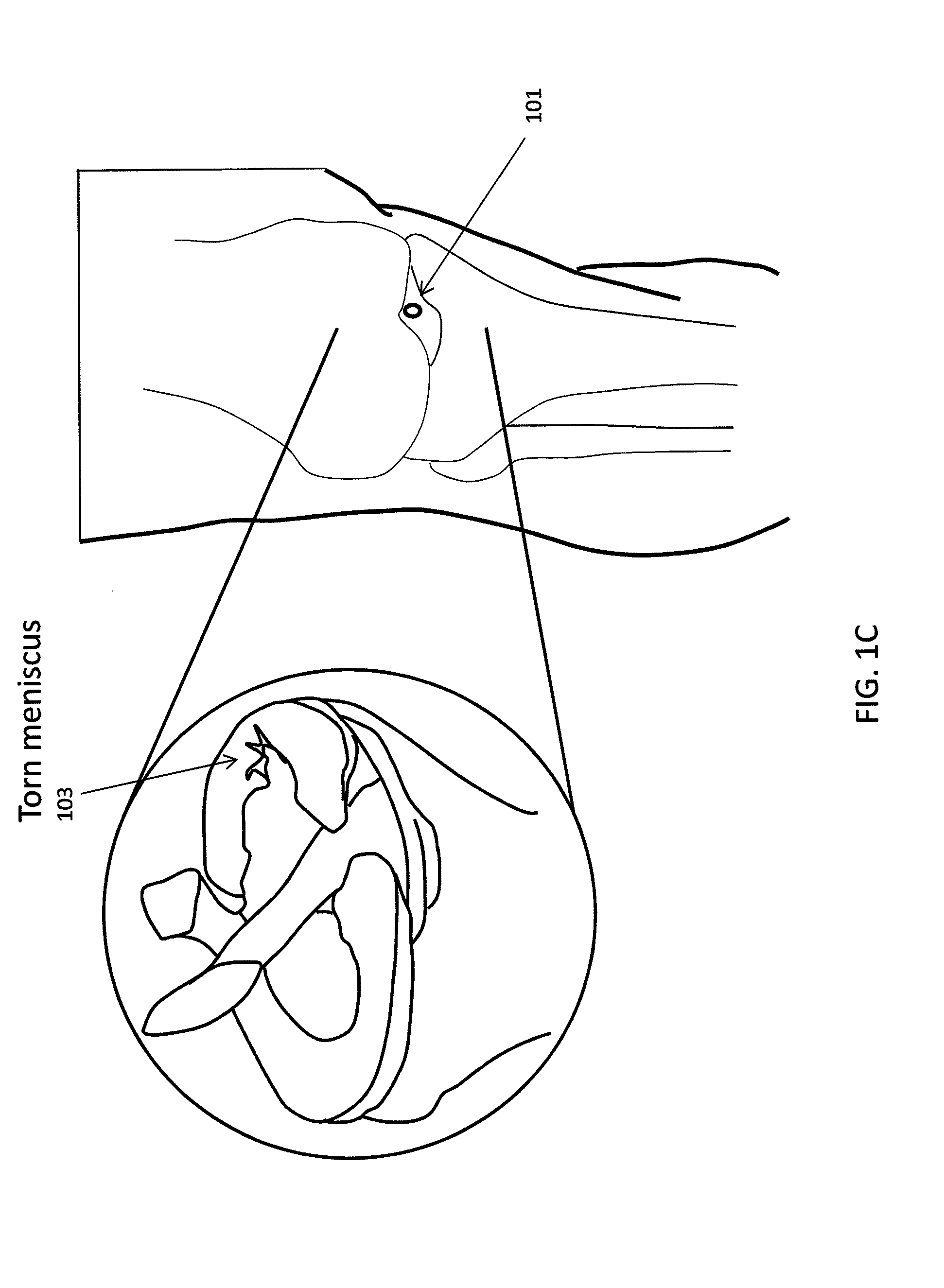 Methods and devices for preventing tissue bridging while suturing
