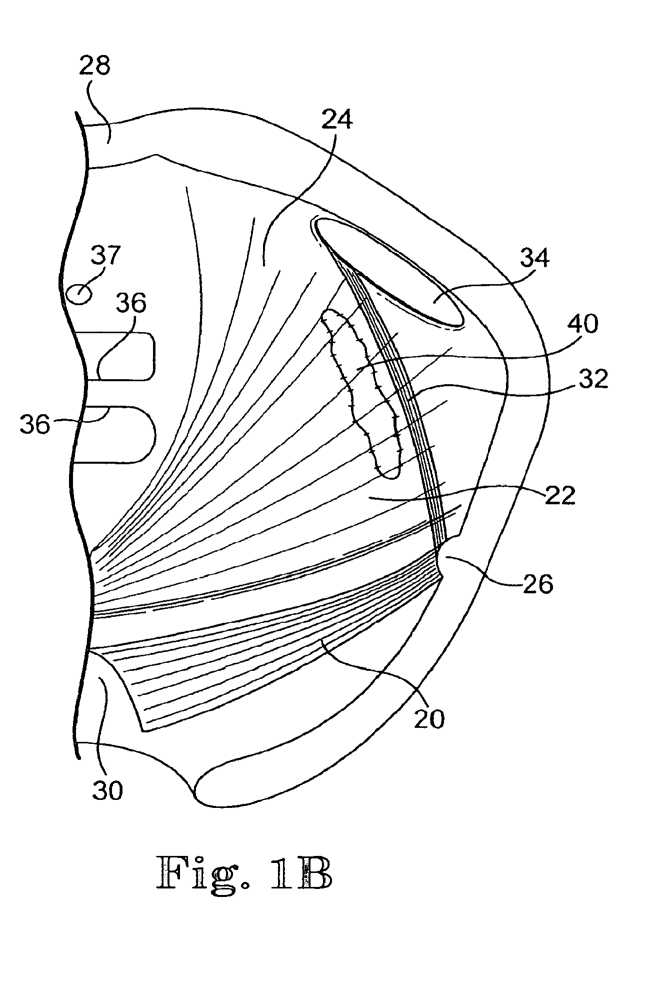 Minimally invasive levator avulsion repair