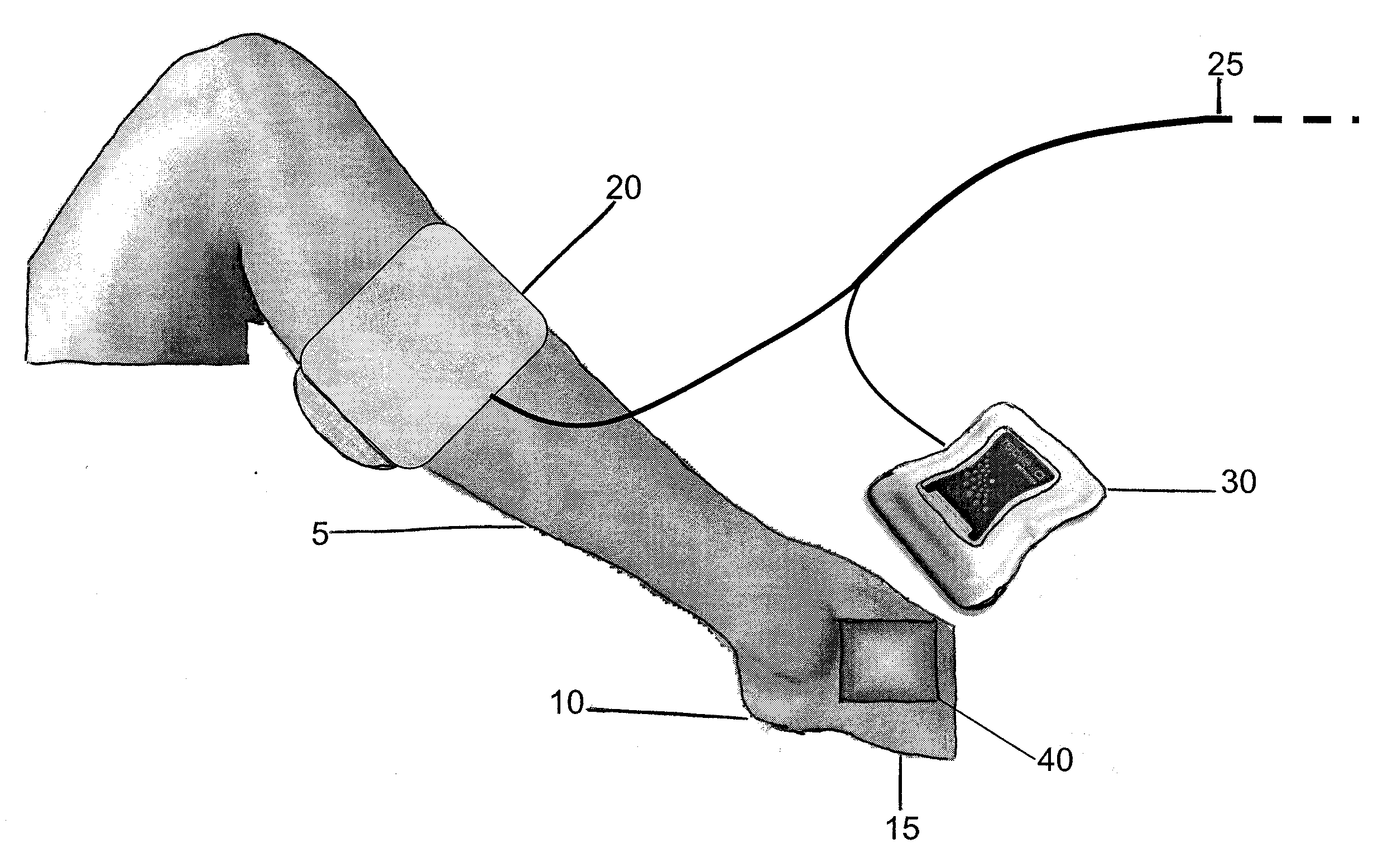 Method of treating a severe diabetic ulcer