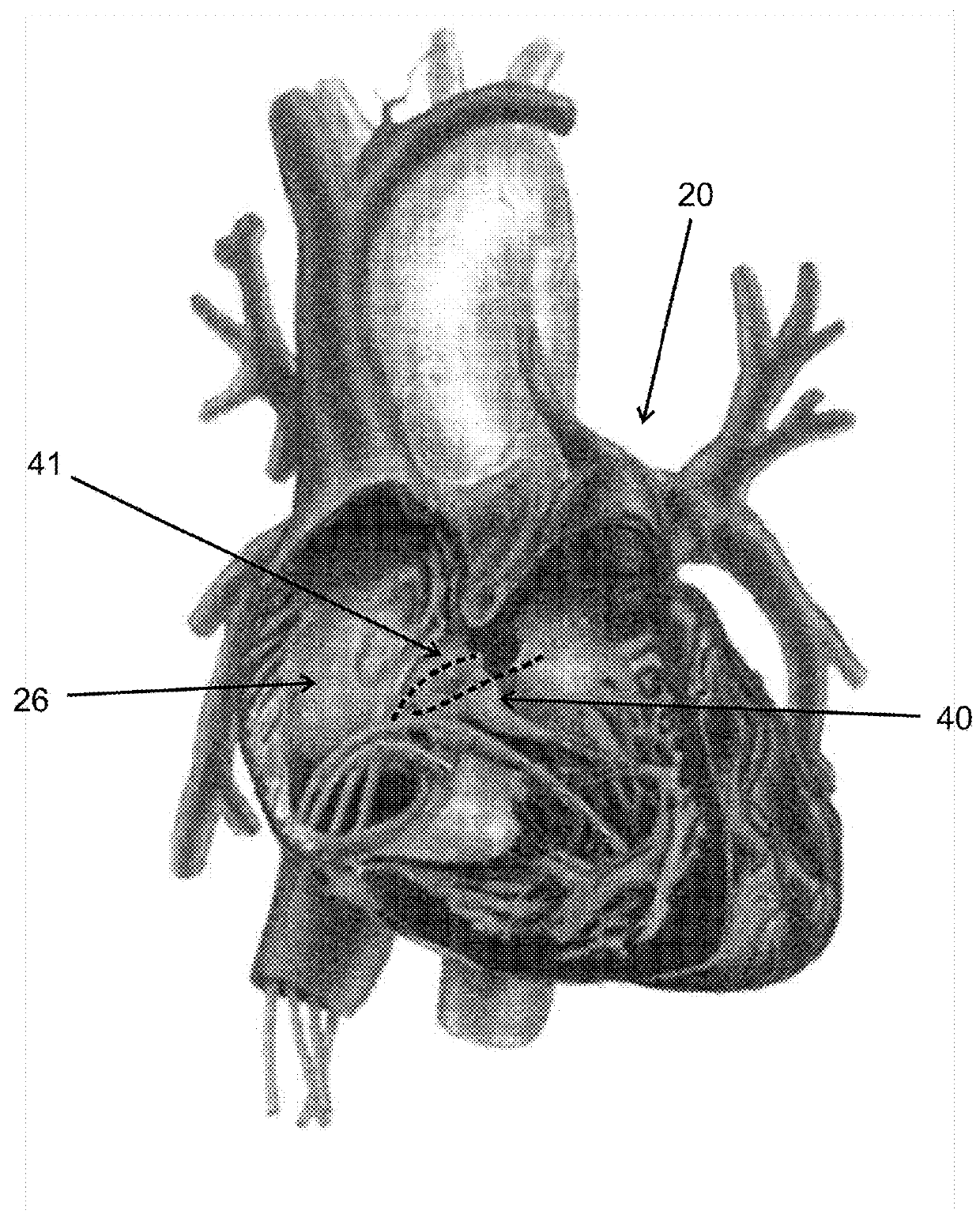 Cardiac stimulation of atrial-ventricle pathways and/or associated tissue