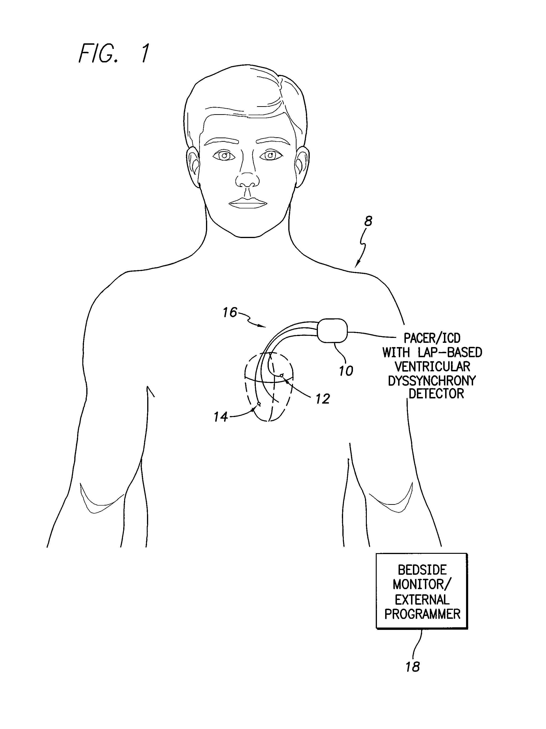 Systems and methods for evaluating ventricular dyssynchrony using atrial and ventricular pressure measurements obtained by an implantable medical device