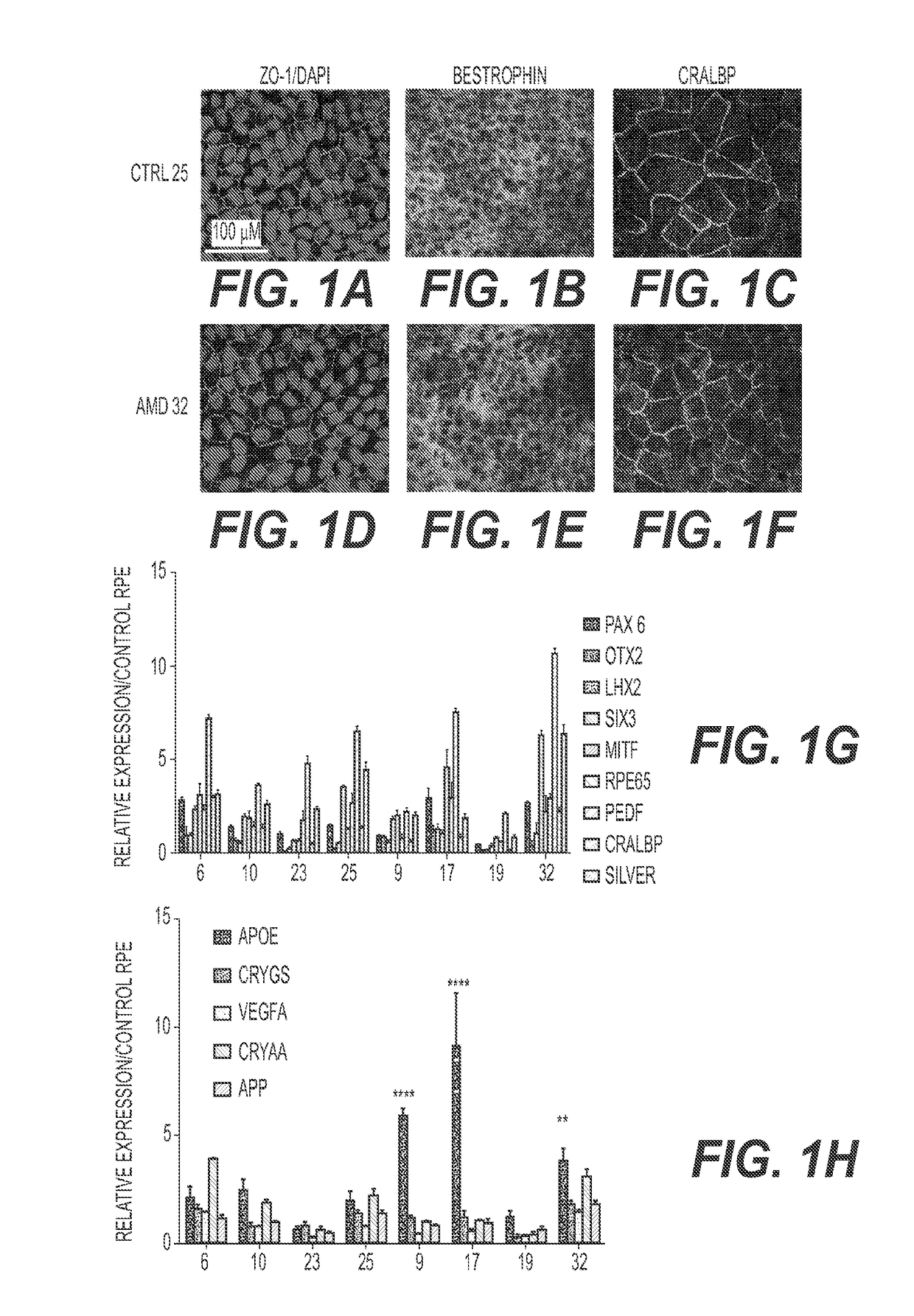 Compositions and methods for the diagnosis and treatment of age-related macular degeneration