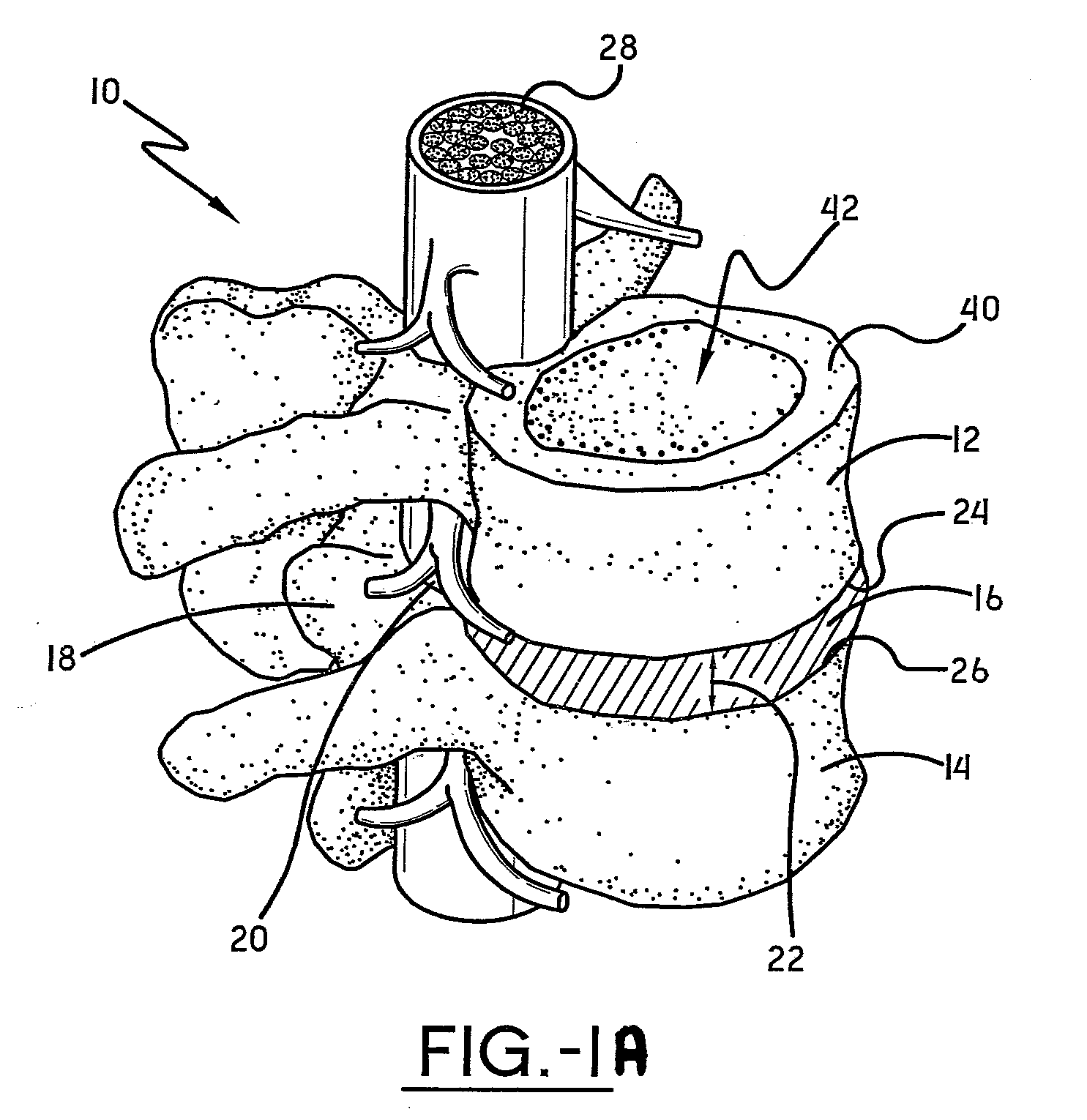 Spine surgery method and inserter