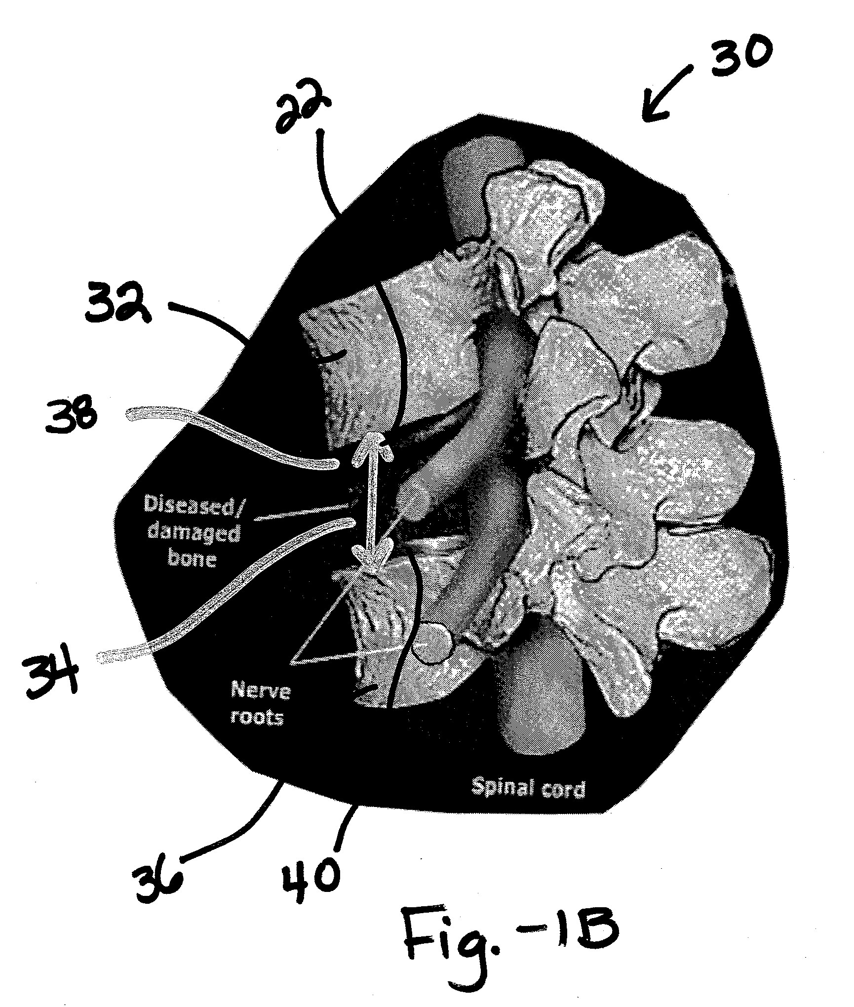 Spine surgery method and inserter