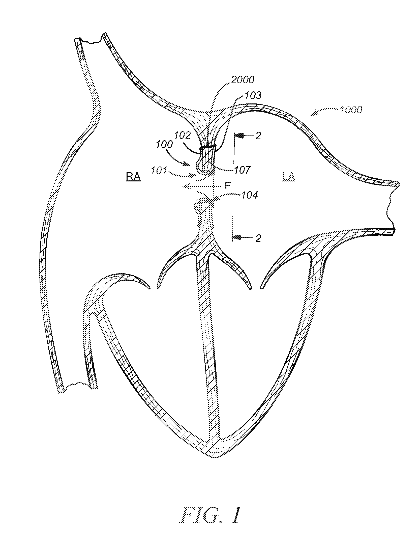 Prosthesis for reducing intra-cardiac pressure having an embolic filter