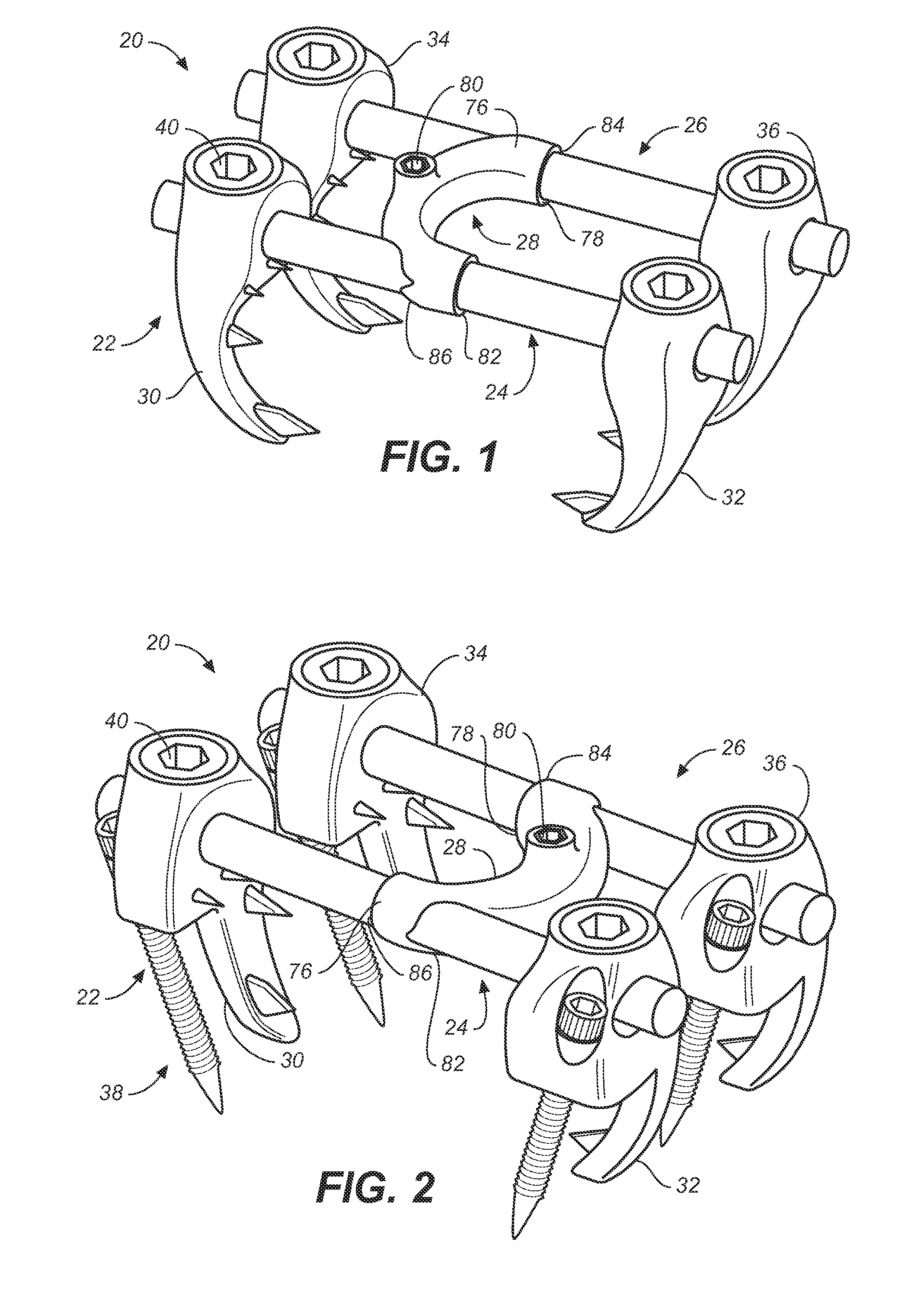 Implant system and method to treat degenerative disorders of the spine