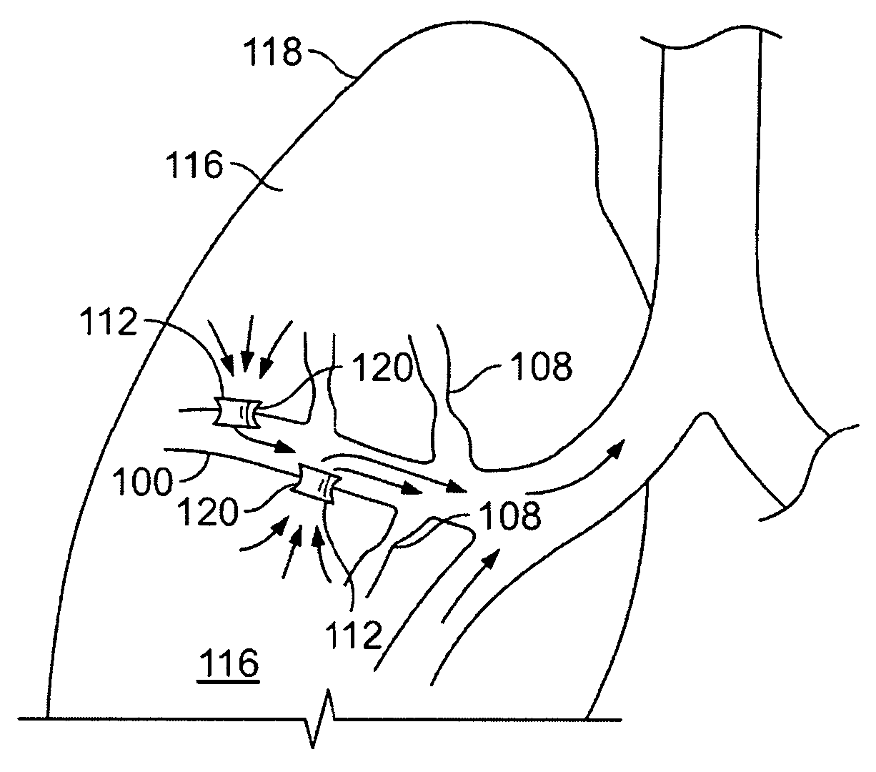 Devices for creating passages and sensing blood vessels