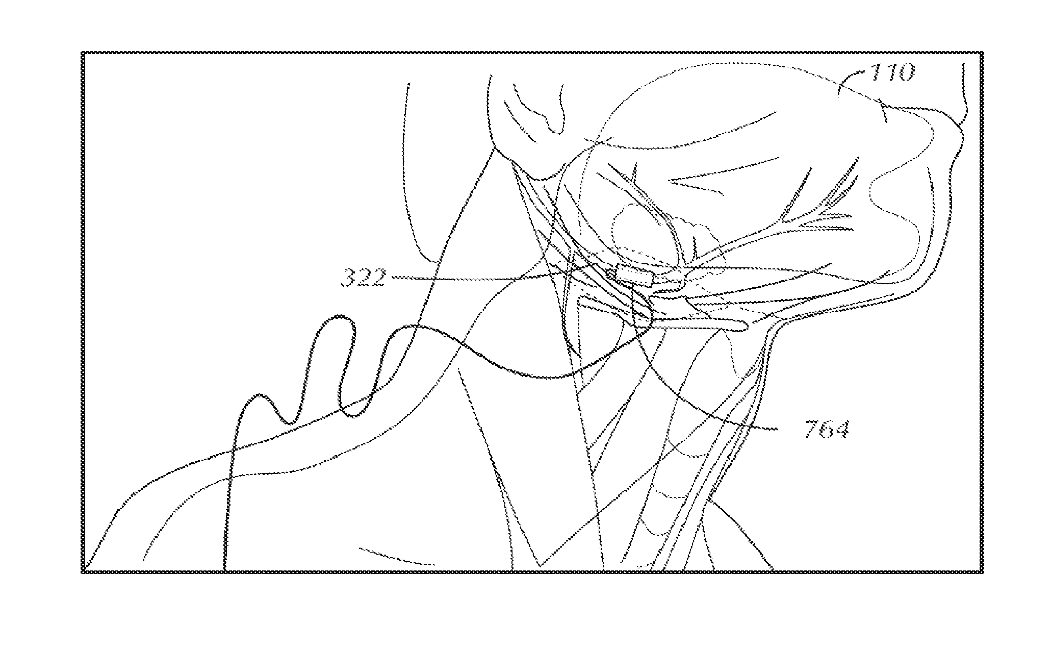 Stimulation of a Hypoglossal Nerve for Controlling the Position of a Patient's Tongue