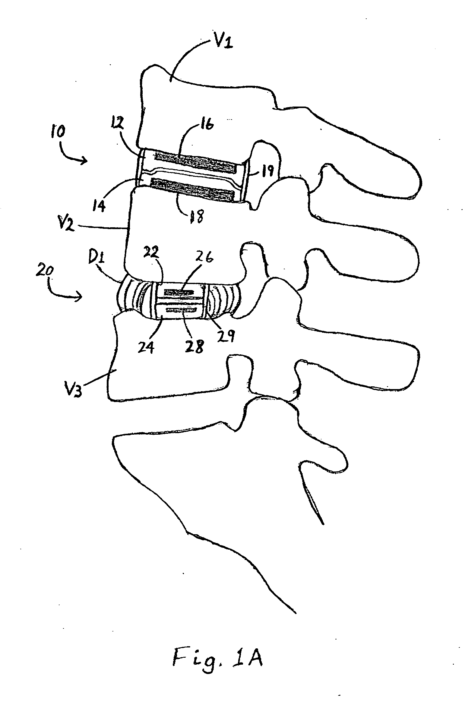 Magnetic spinal implant device